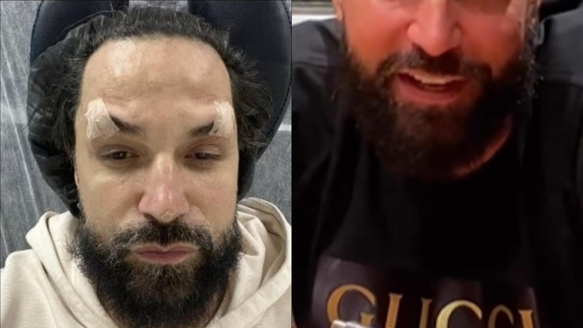 Menos inchado, Latino mostra resultado do rejuvenescimento facial: “Um pouco melhor”