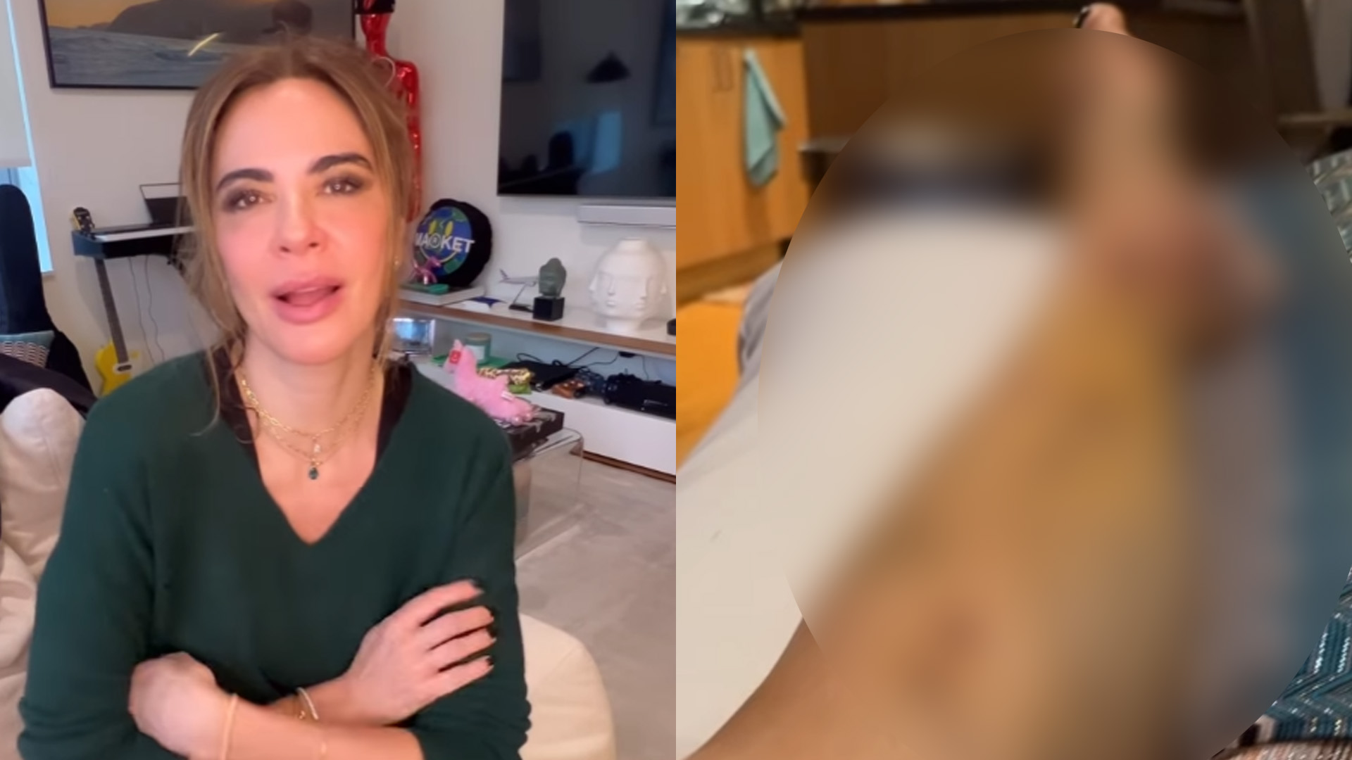 Luciana Gimenez mostra perna após acidente em imagens fortes: “Não se assustem”