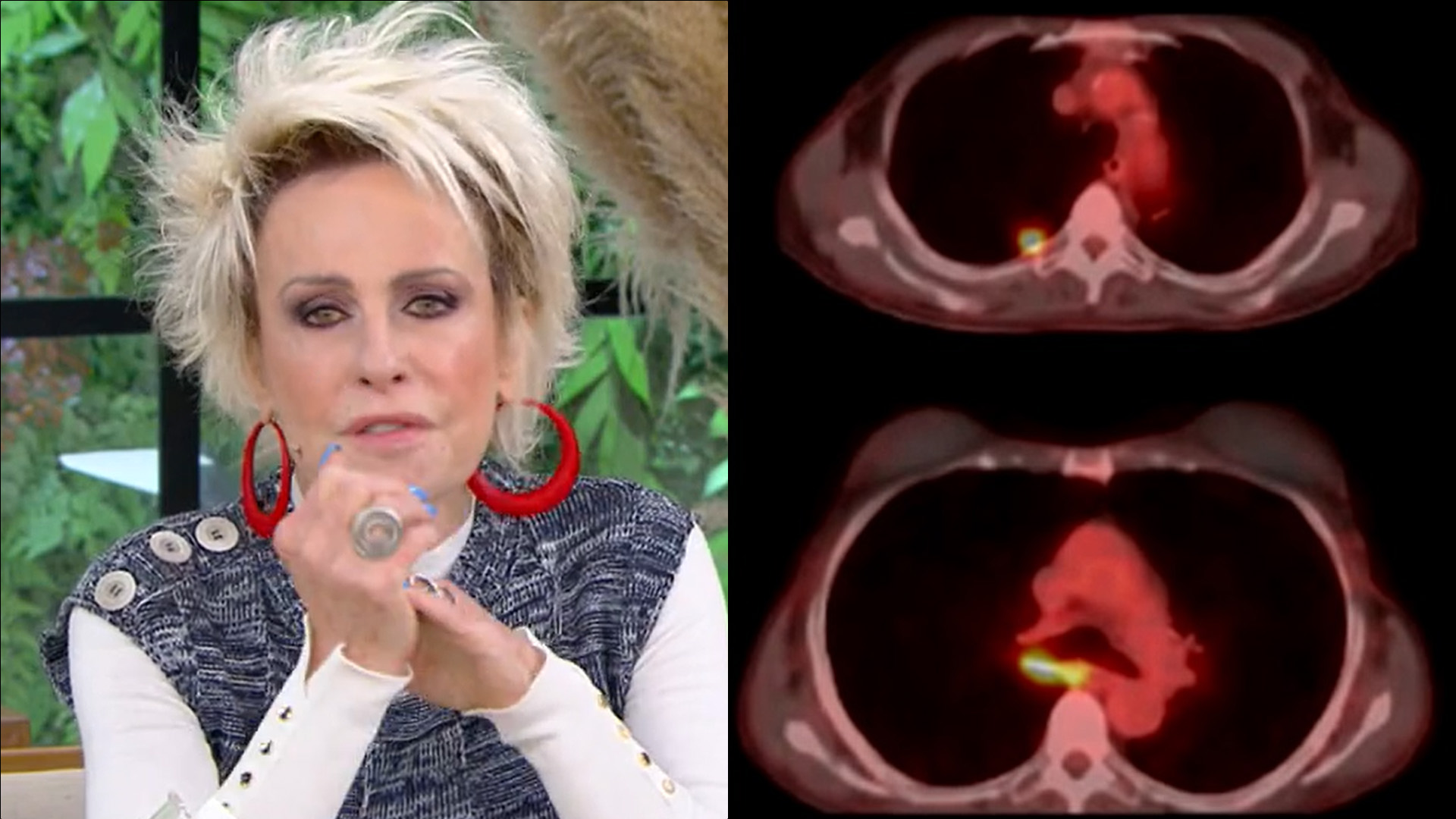 Ana Maria Braga mostra imagens inéditas de câncer gravíssimo que enfrentou: “Era preocupante”