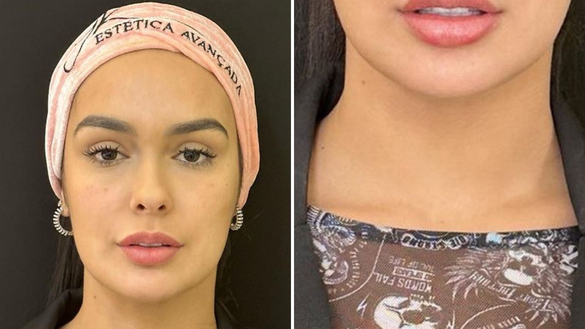 Ex-BBB Larissa Santos realiza harmonização facial e resultado choca: “Caramba”