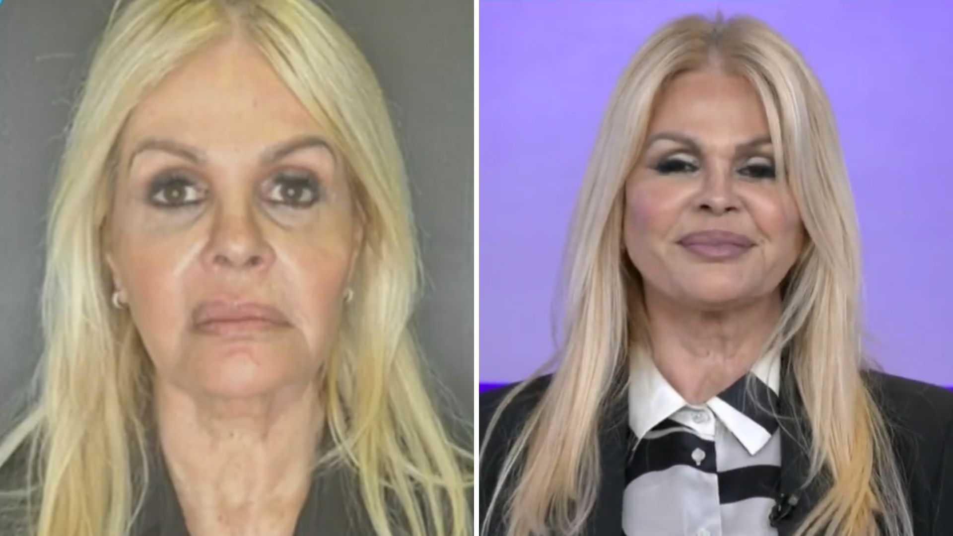 Monique Evans mostra transformação com harmonização facial: “Tão feliz”