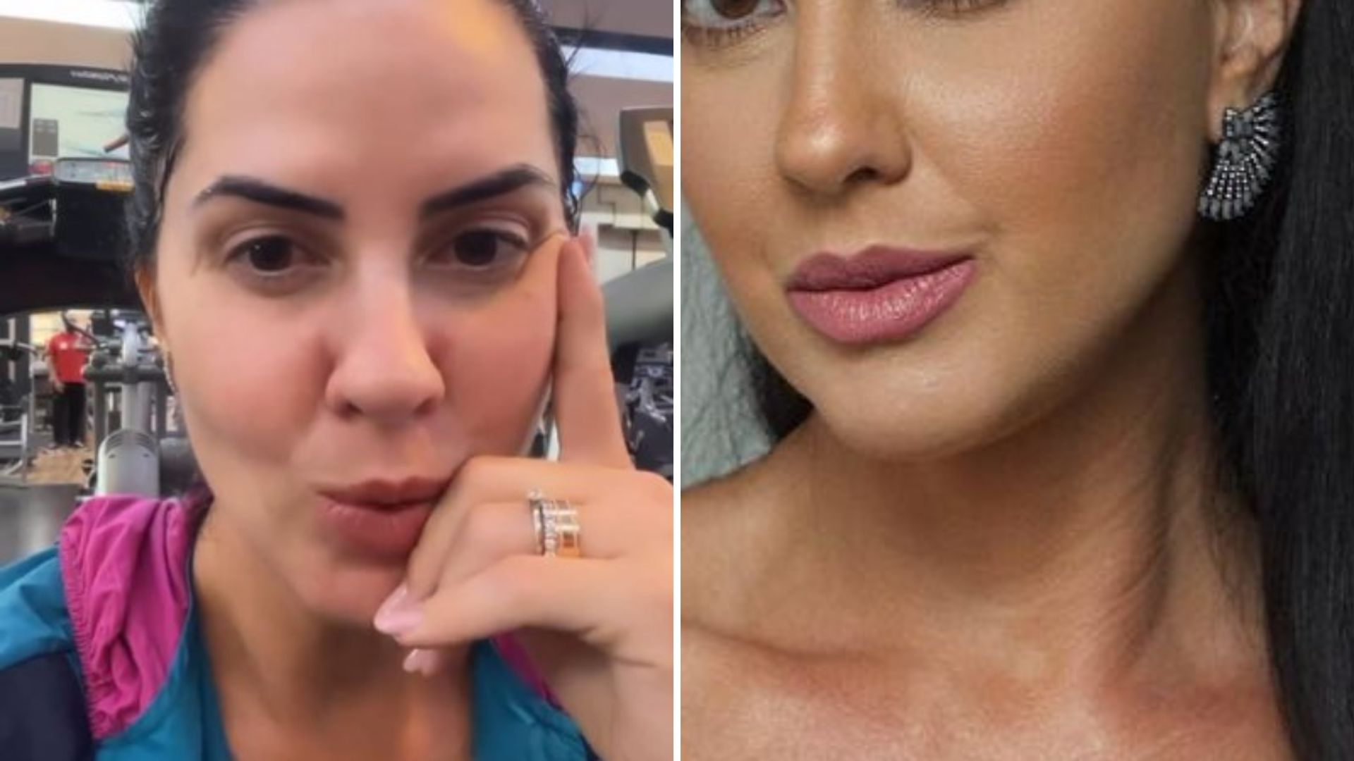 Exagerou? Graciele Lacerda precisa se explicar ao aparecer com rosto mudado: “Harmonização?”