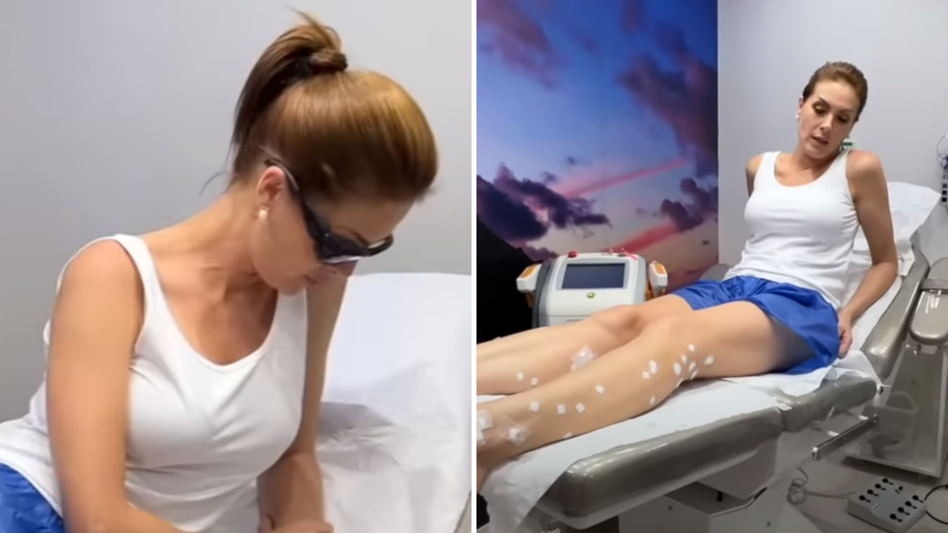 Ana Hickmann expõe problemas nas pernas: “Sofro com isso há muito tempo”