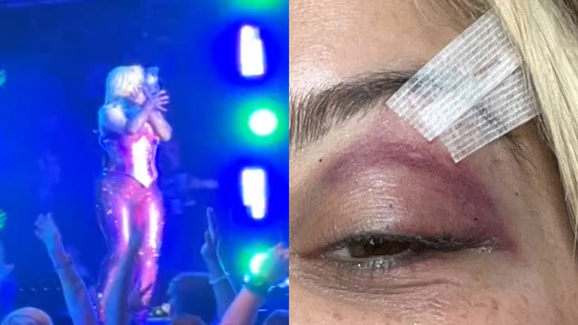 Precisou de pontos! Cantora é atingida por celular no rosto durante show