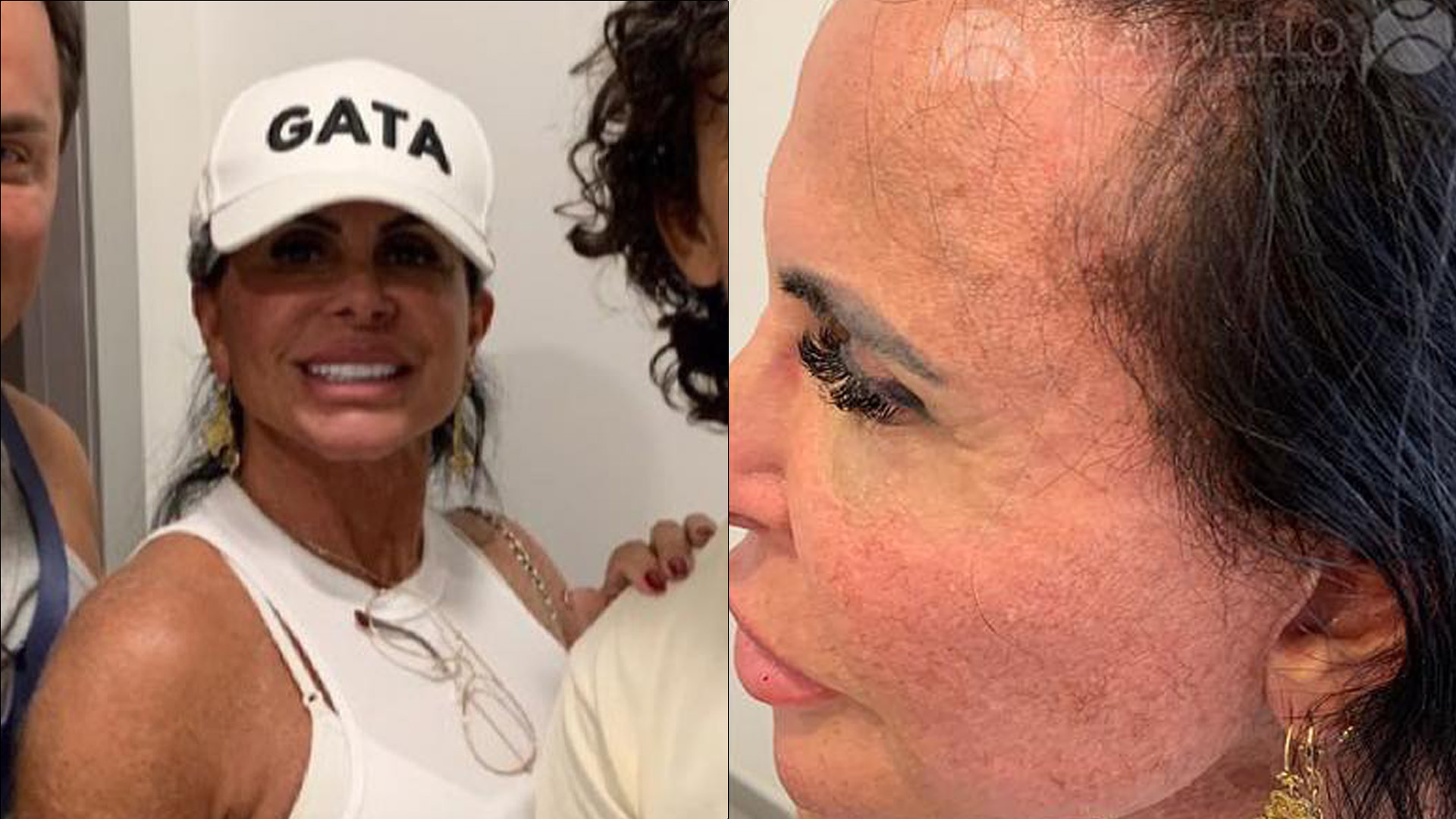 Aos 64 anos, Gretchen sofre com falta de cabelo e expõe calvície: “Autoestima”