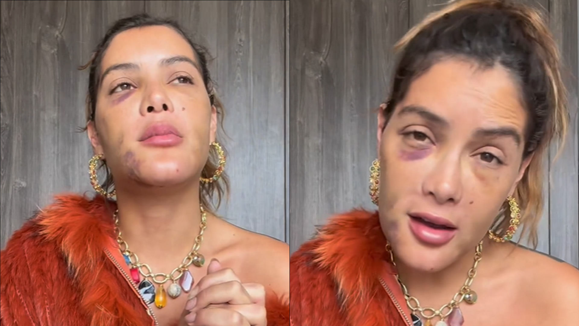 Atriz da Globo faz cirurgia de emergência após descobrir câncer no rosto: “Quase morri”