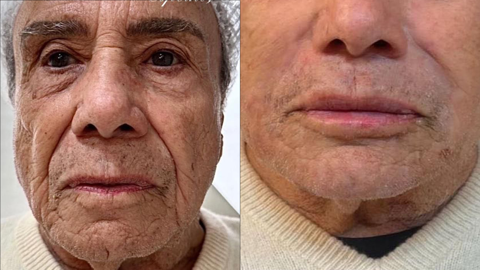 Stênio Garcia se revolta com ataques por fazer harmonização aos 91 anos: “C*guei”
