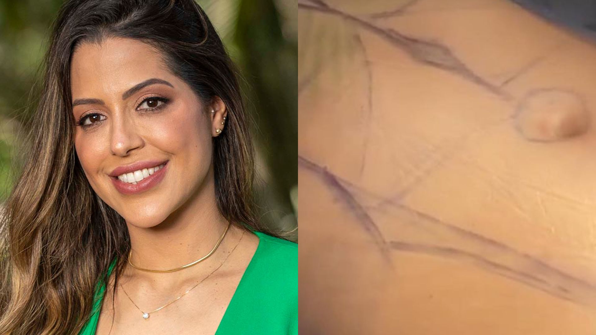 Ex-BBB Laís Caldas divide opiniões ao revelar resultado da lipo: “Sem noção”