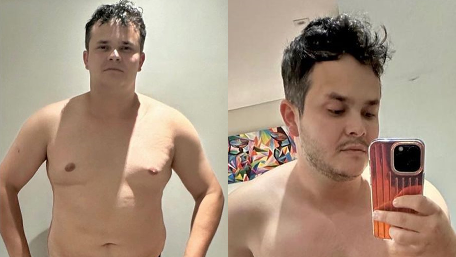 Matheus, da dupla com Kauan, surpreende ao exibe antes e depois de lipo