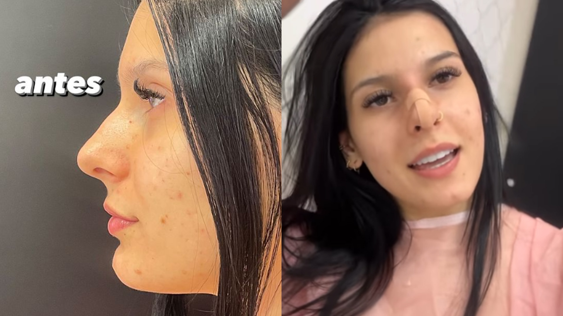 Ana Castela remodela nariz totalmente e mostra antes e depois: “Ficou super natural”