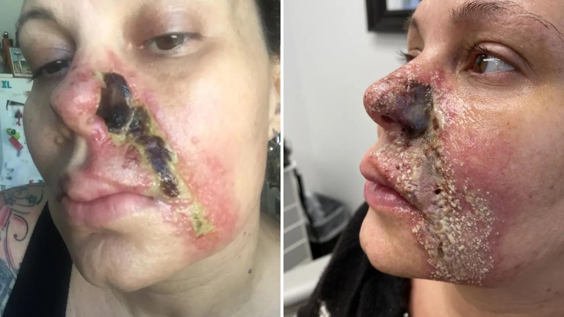 Mulher perde parte do nariz e tem pele necrosada após procedimento estético: “Apavorada”
