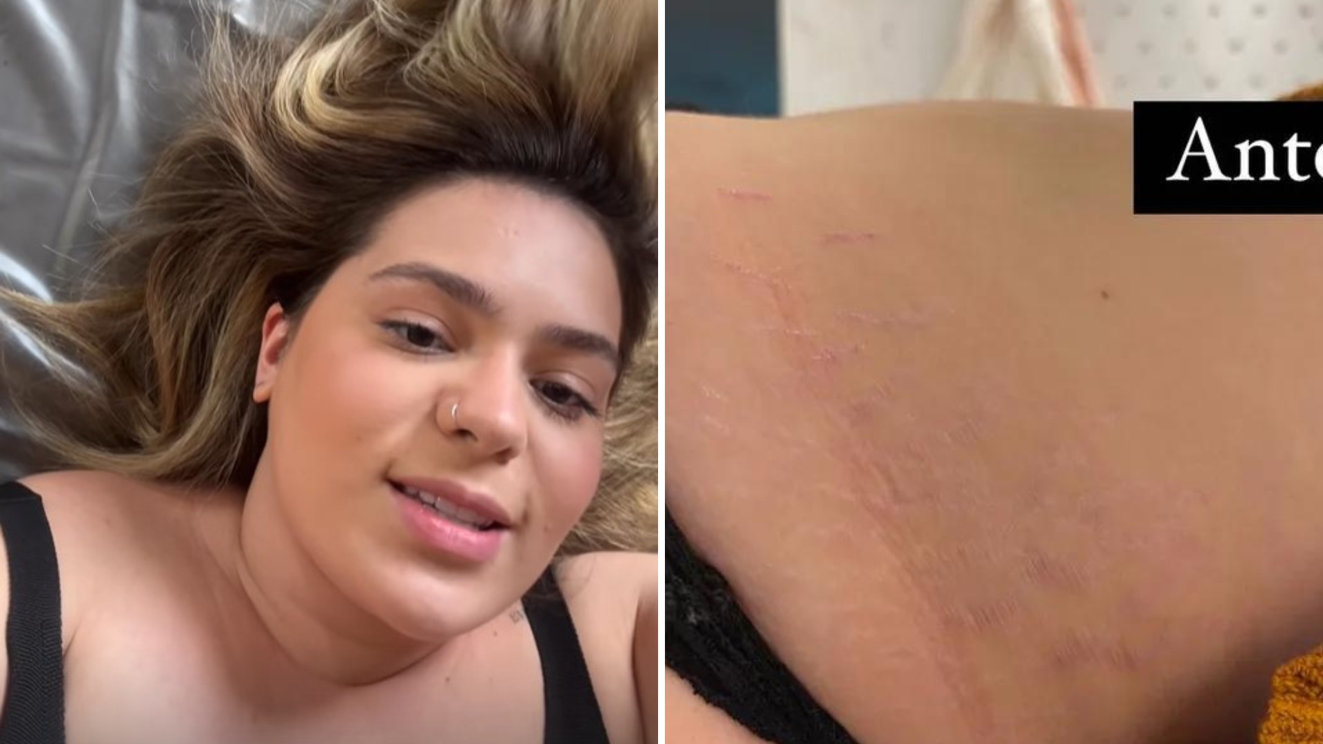 Viih Tube mostra antes e depois de tratamento contra estrias: “Fez muita diferença”