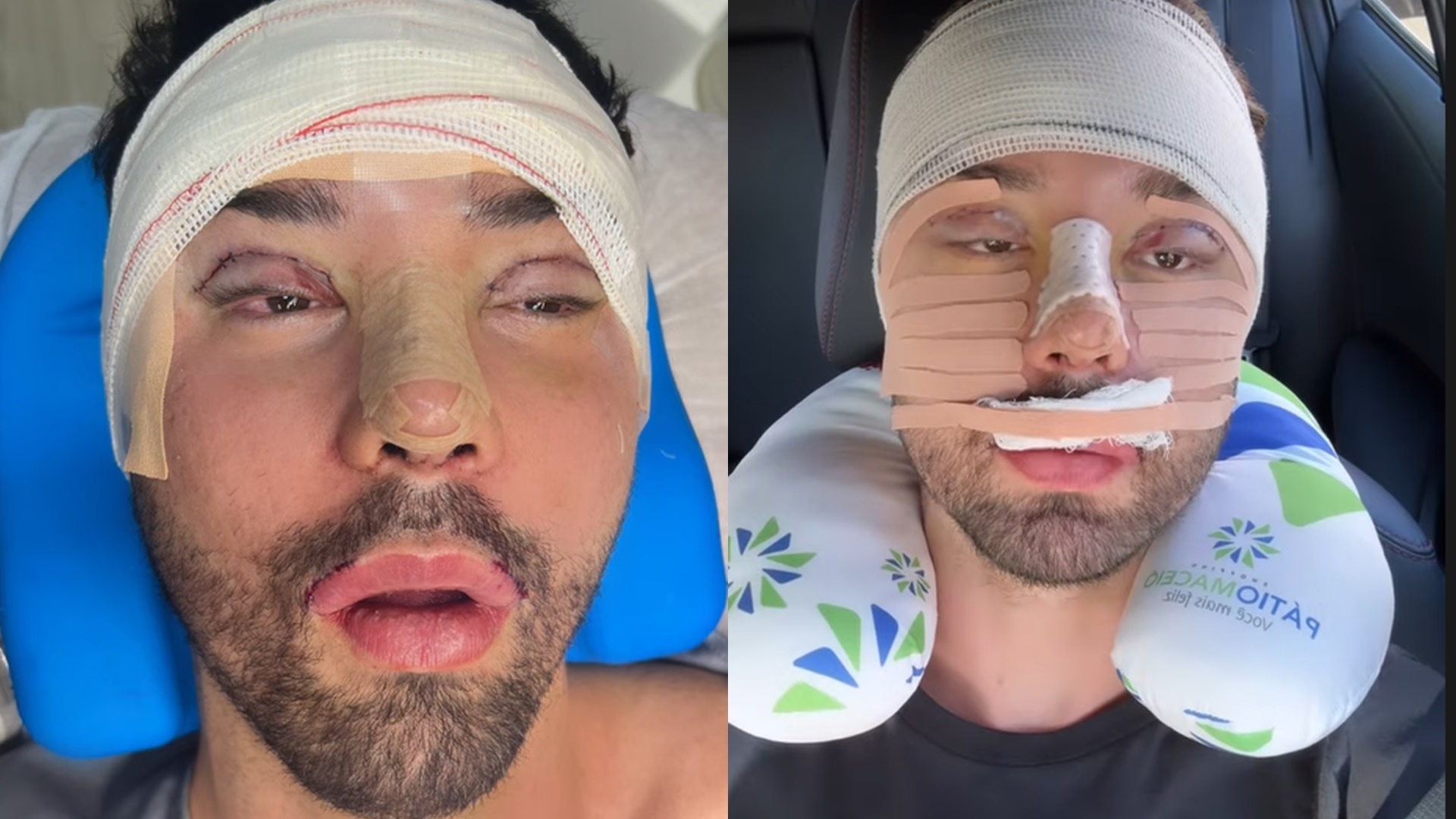 Rico Melquiades passa por nova cirurgia após ser chamado de feio: “Mexe muito comigo”