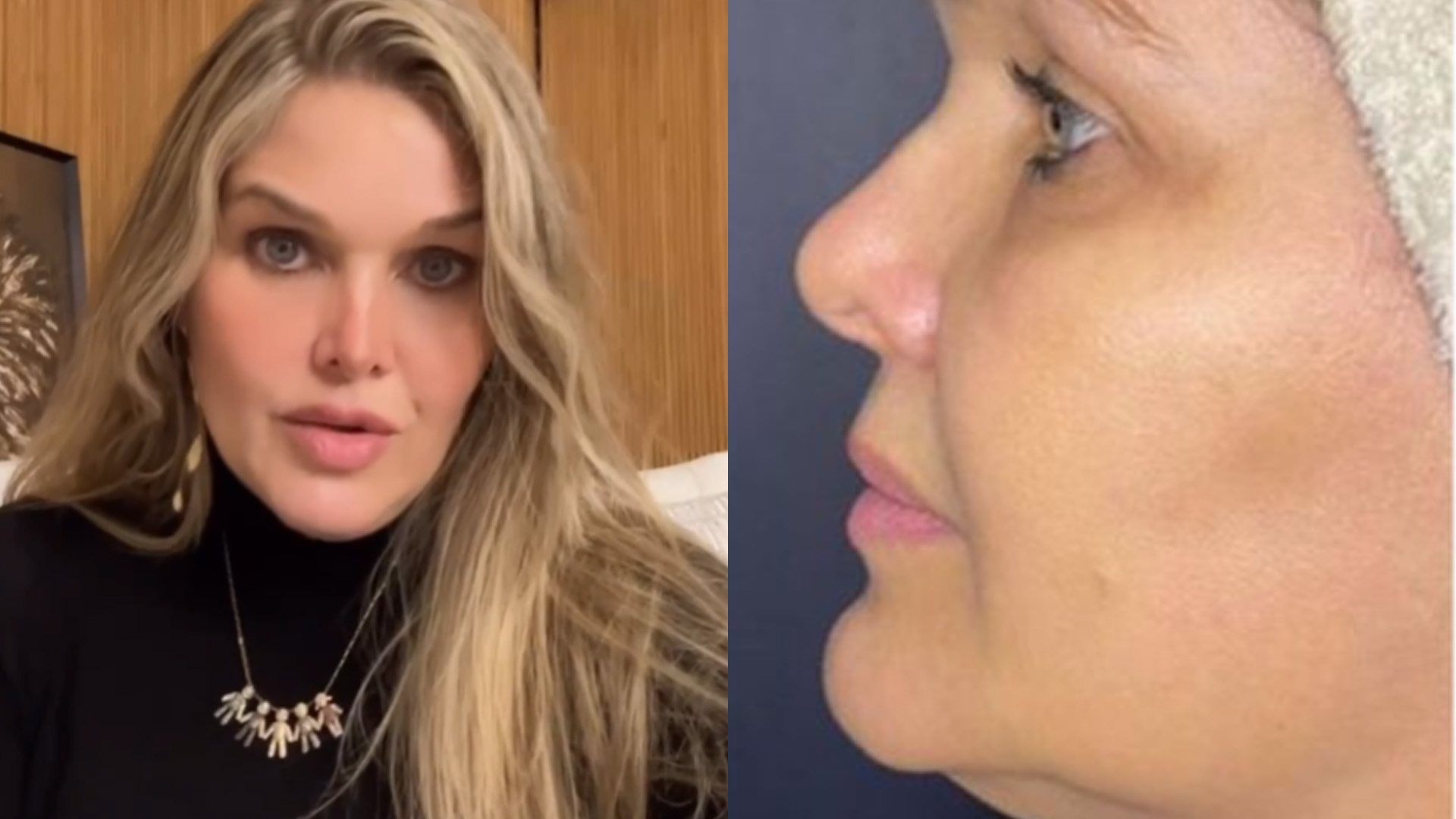 Que diferença! Viúva de Leandro revela resultado de procedimento no rosto: “Pele linda”