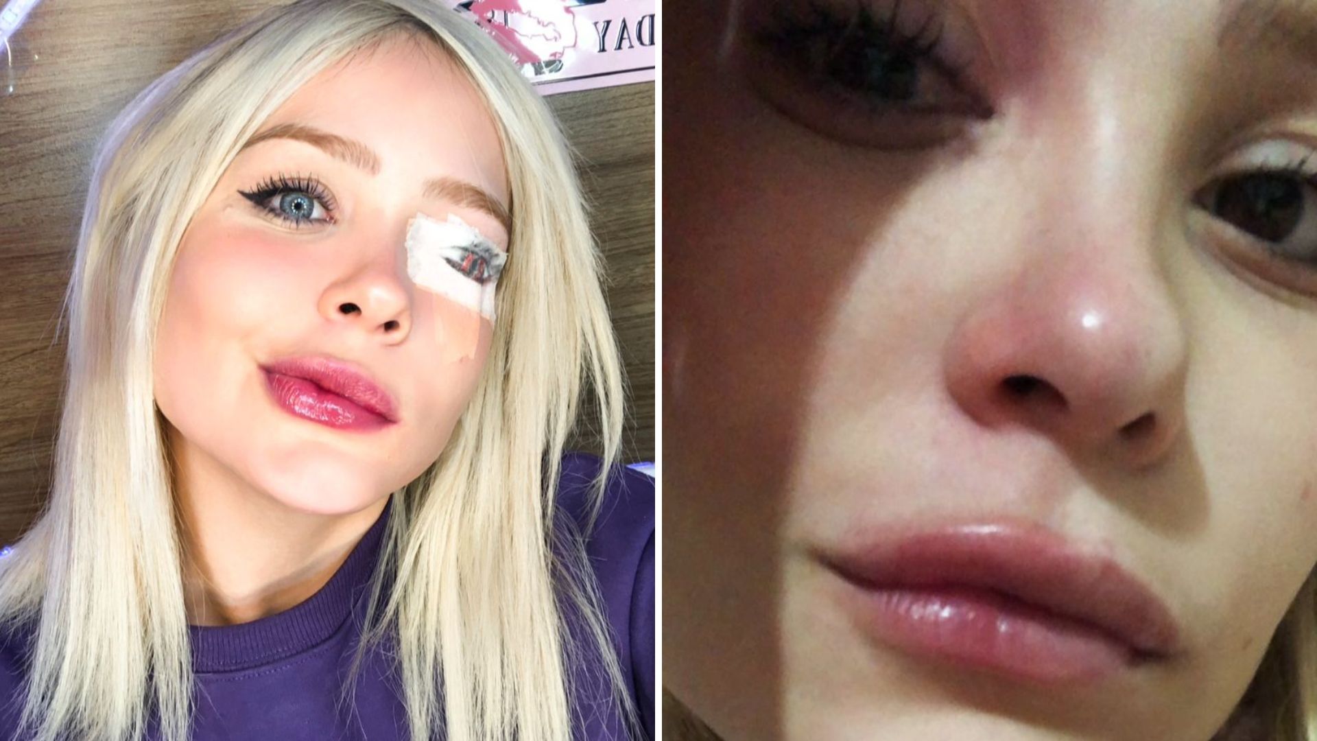Influenciadora famosa narra desespero ao ter múltiplas paralisias faciais: “Carrego sequelas”