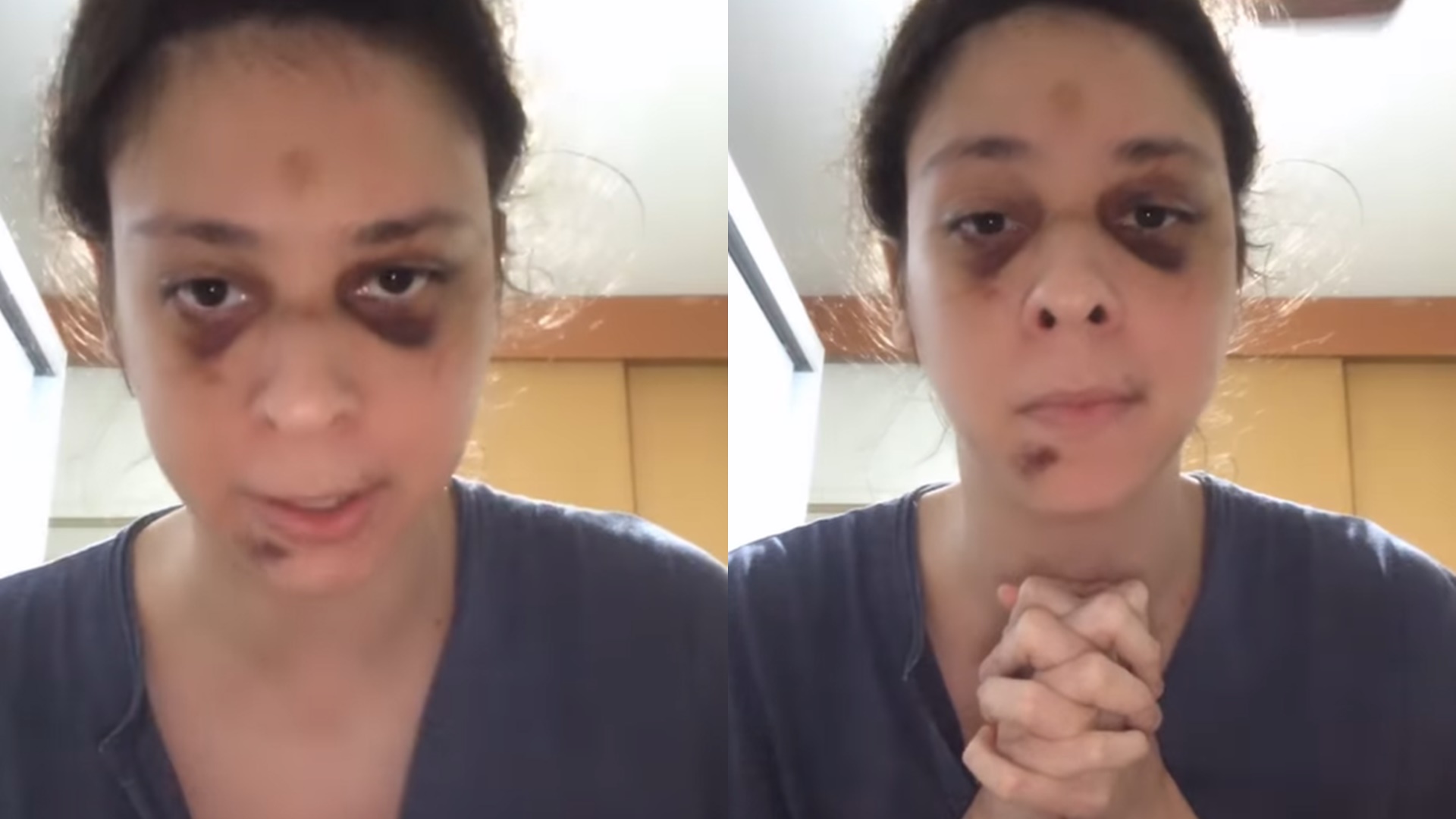 Victor Meyniel exibe marcas de agressão após ser covardemente espancado: “Vai passar”