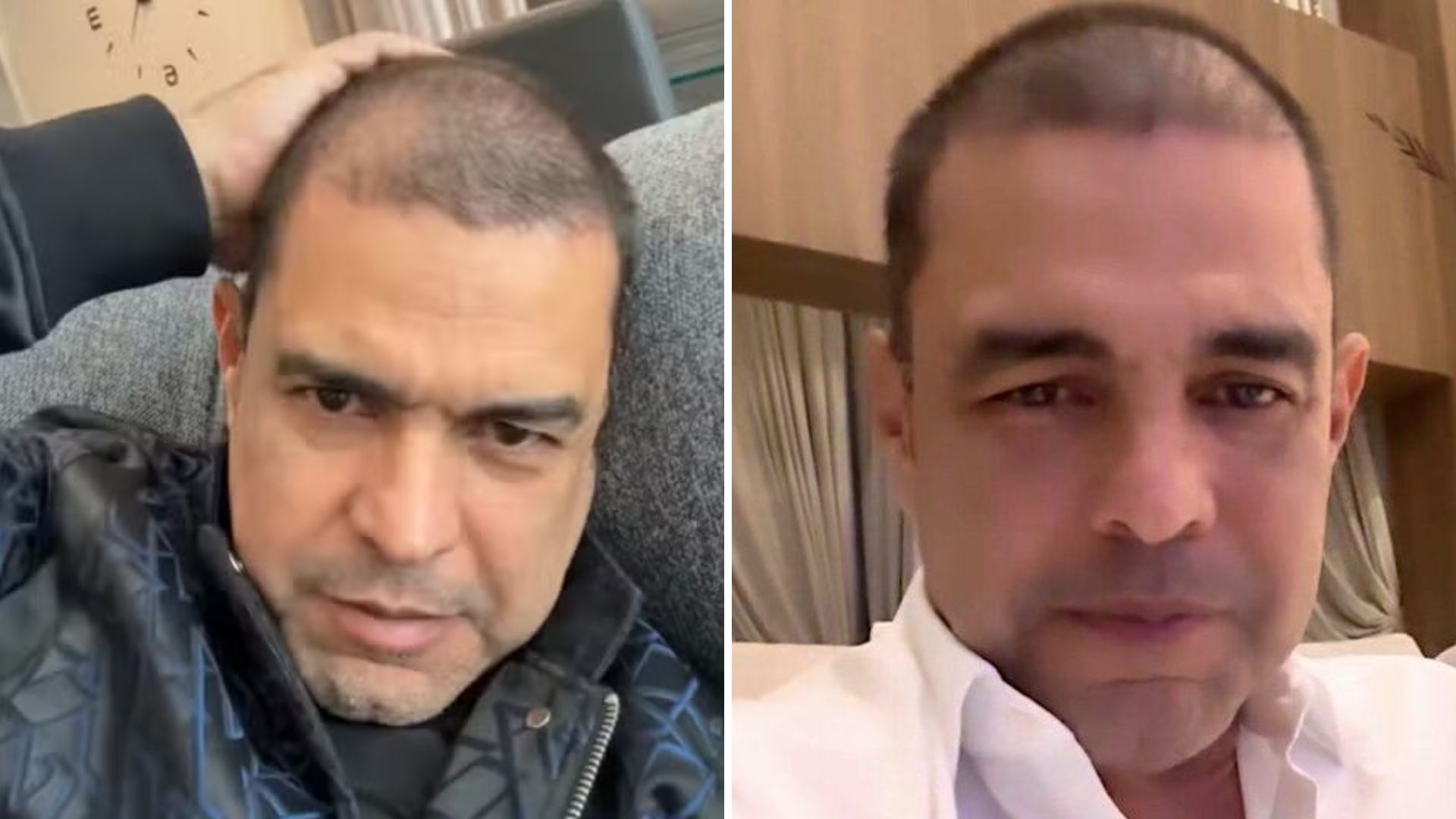Quanto Zezé Di Camargo gastou com transplante capilar? Valor não é nada sútil