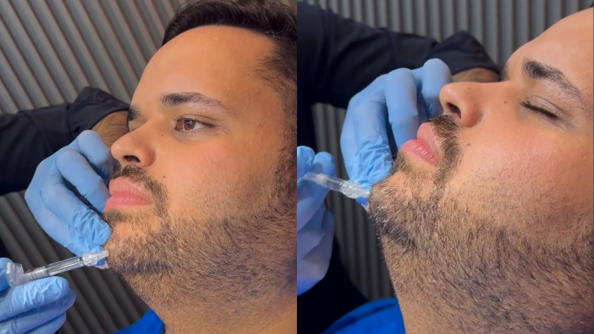 Ex-BBB Michel faz lipo de papada e surpreende com resultado: “Maravilhoso”