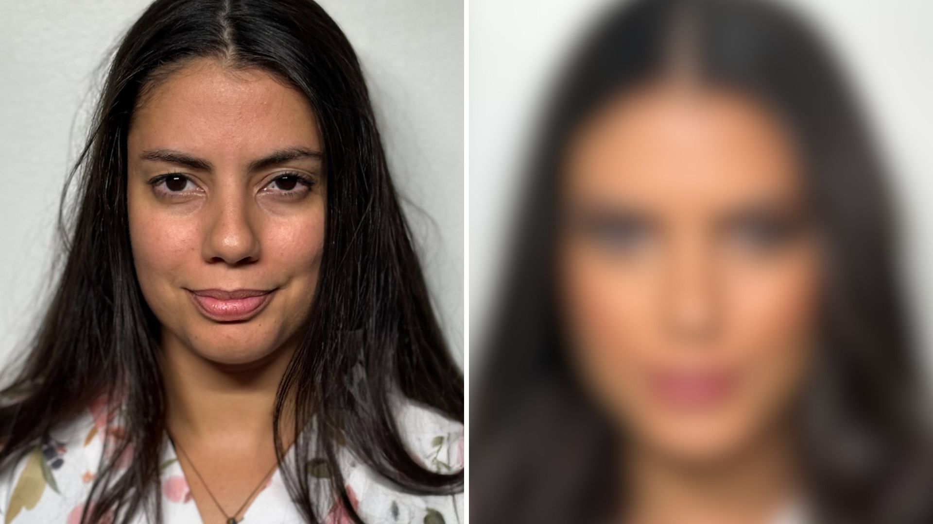 Fernanda faz procedimentos horas após eliminação do BBB 24; veja antes e depois