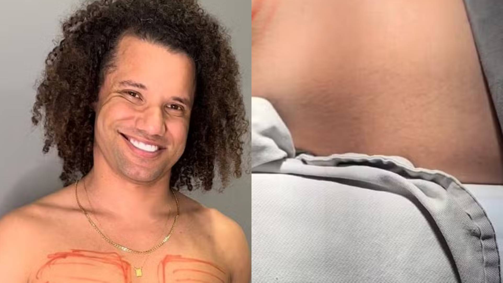 Ex-BBB Maycon faz preenchimento no bumbum e choca com resultado: “Maior”