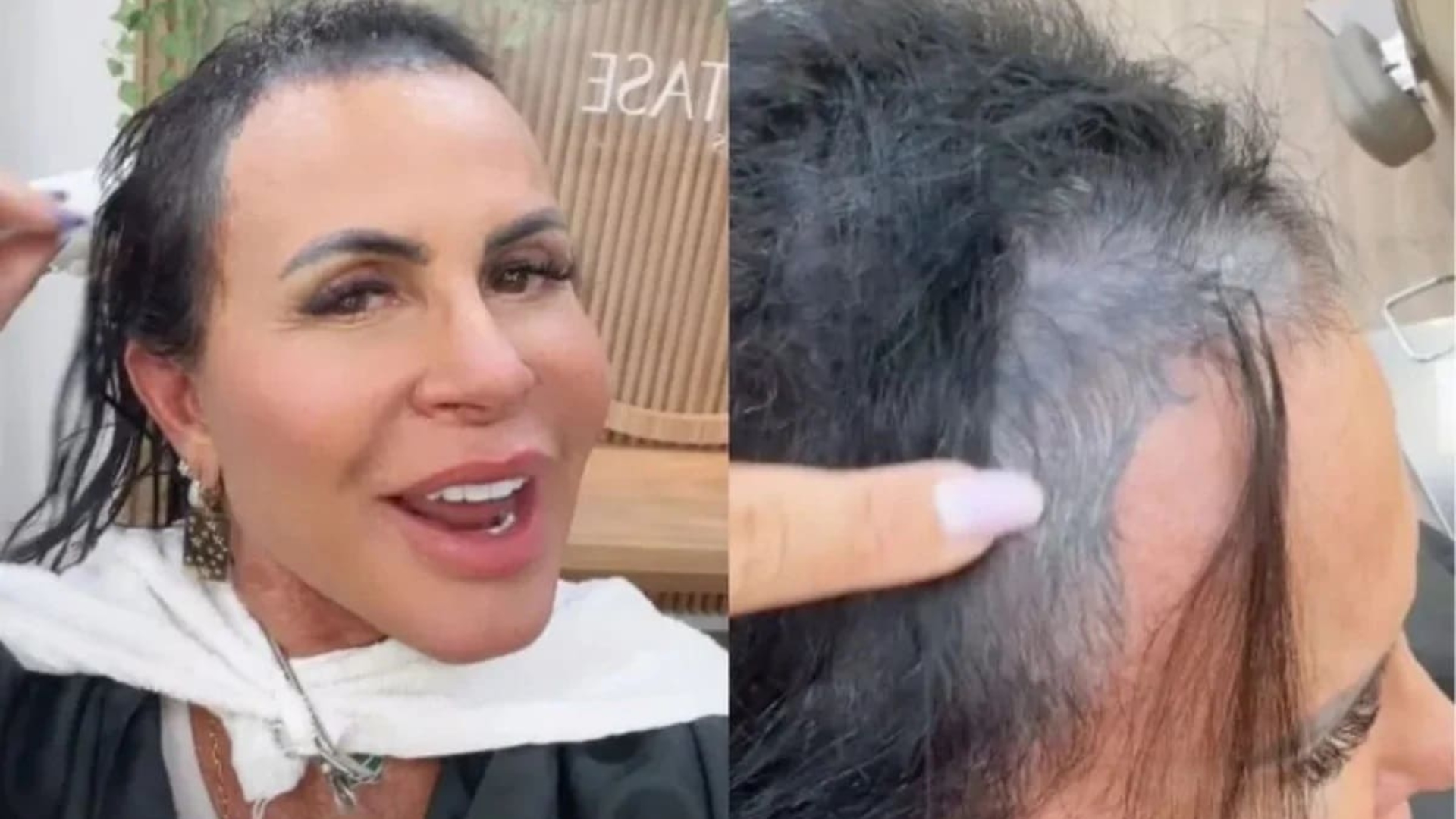 O que é corte químico e alopecia? Médica explica problemas enfrentados por Gretchen