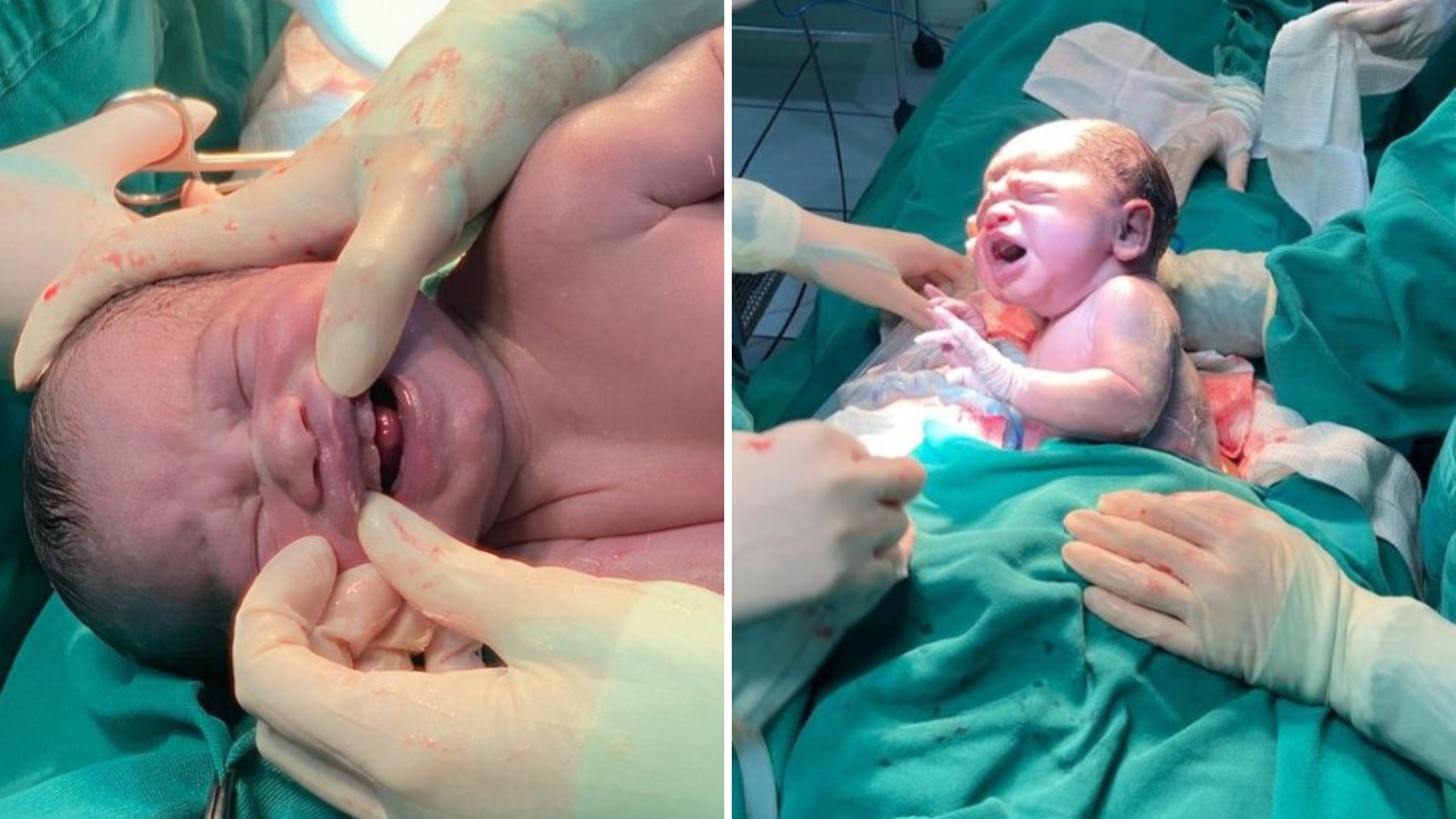 Bebê nasce com ‘dentes’ no MS e surpreende família