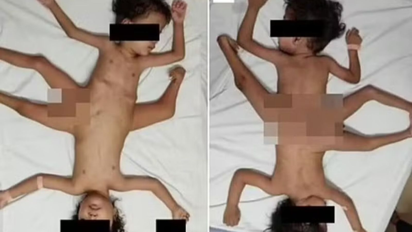 Milagre: gêmeos siameses com condição rara lutam pela vida