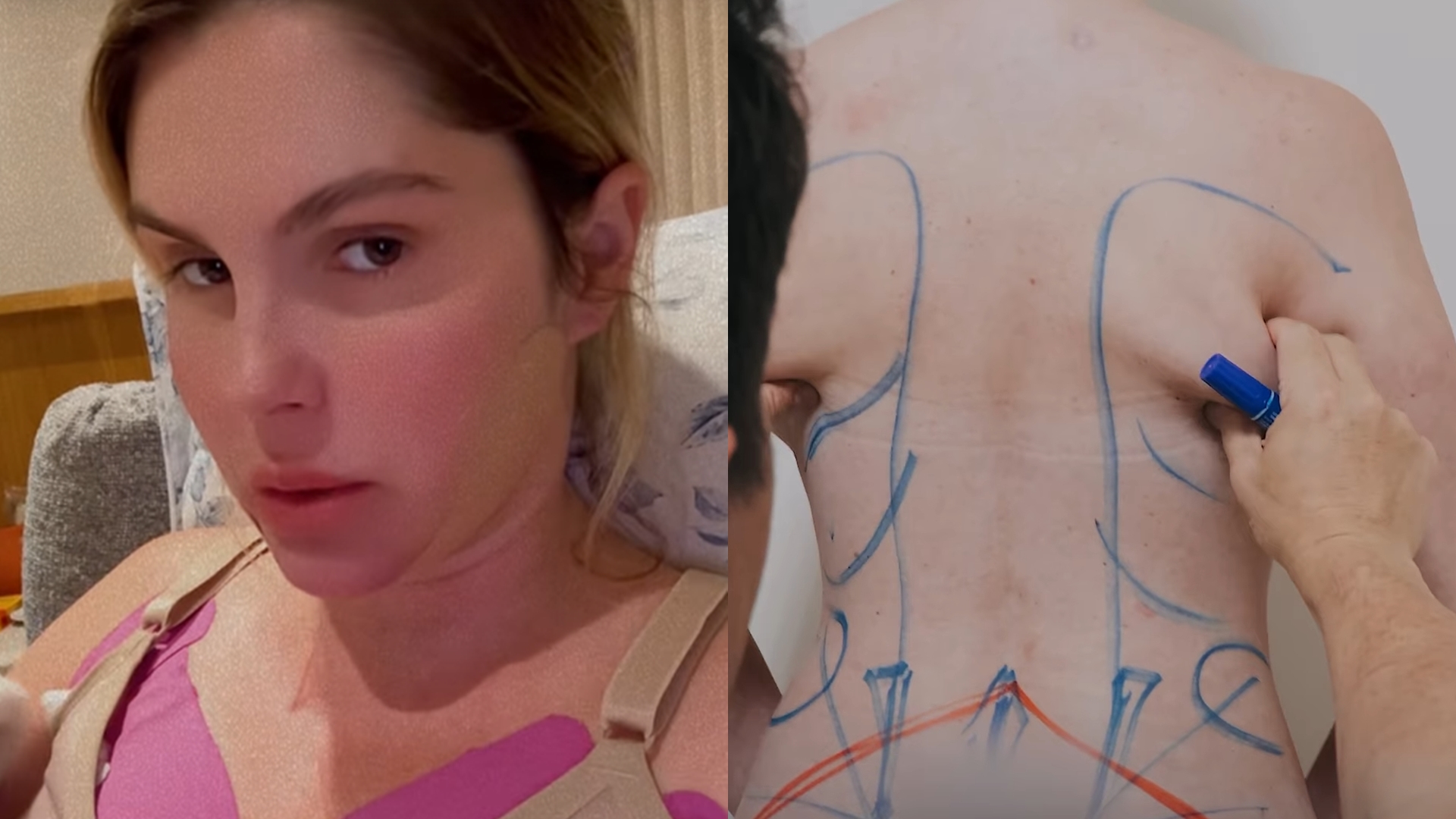Bárbara Evans expõe dificuldades em recuperação de cirurgias plásticas: “Dói muito”
