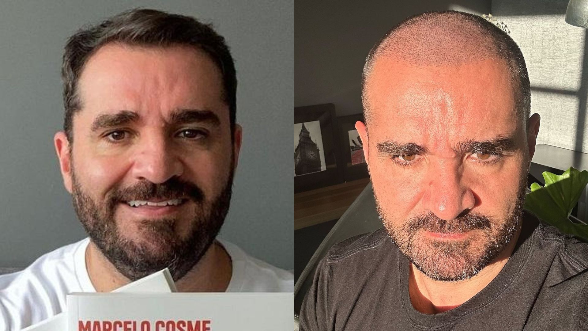 Apresentador da Globo se submete a transplante para deixar de ser calvo