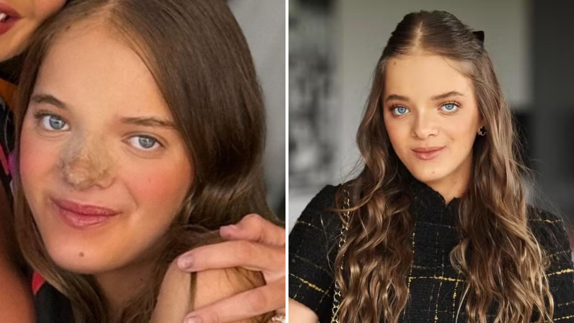Por que Rafaella Justus operou? Entenda quando cirurgia no nariz é recomendada
