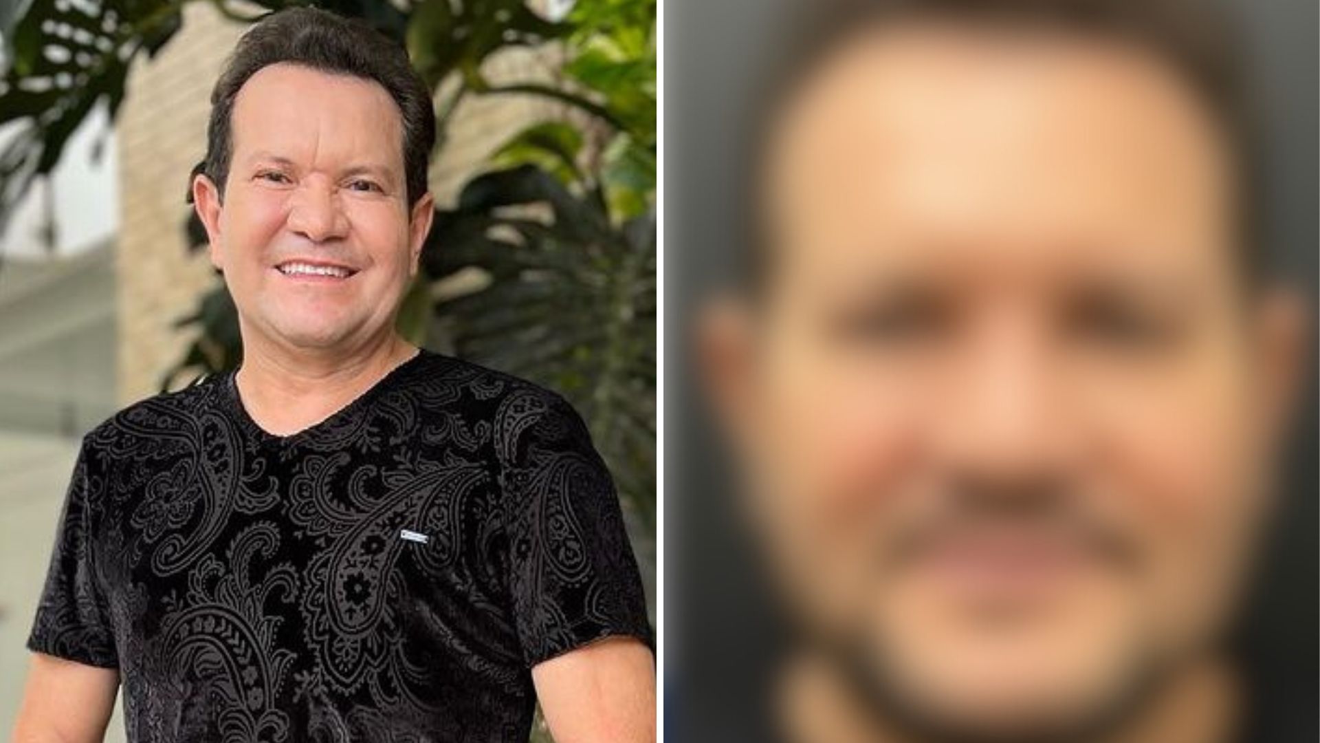 Ximbinha passa por harmonização facial e revela antes e depois: “Não tem preço”