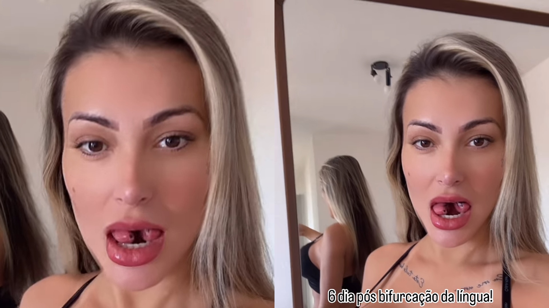 Andressa Urach volta a escovar os dentes após dividir a língua: “Dor está menor”