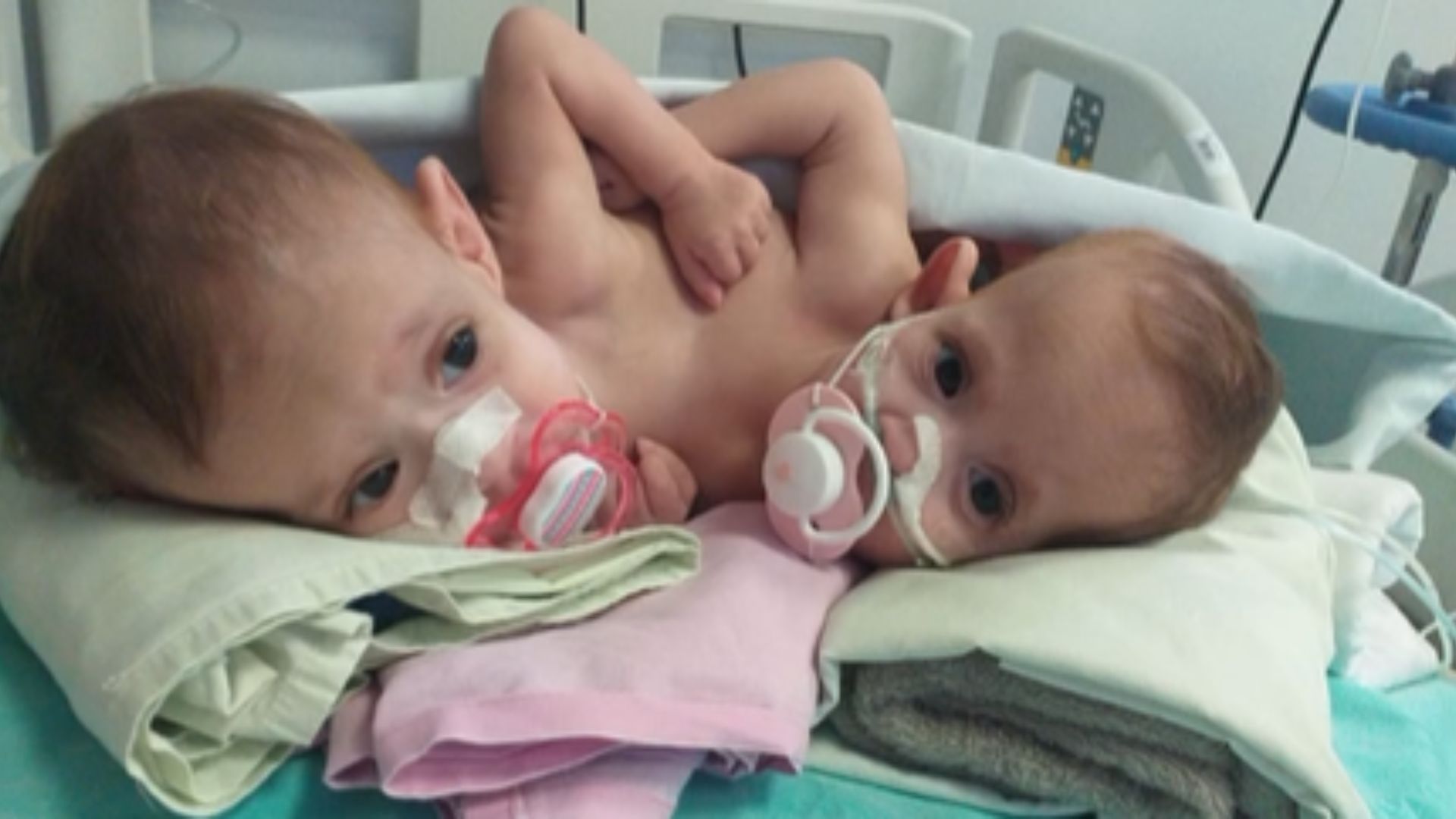 Gêmeas siamesas ligadas pelo peito morrem aos 10 meses: “Não melhoravam”