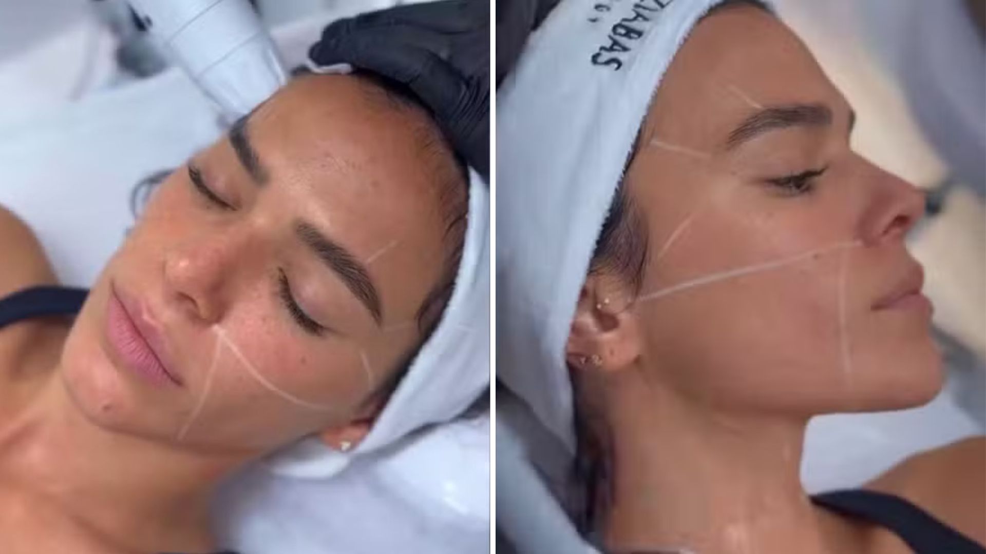 Segredo por trás do novo rosto de Bruna Marquezine vem à tona; descubra