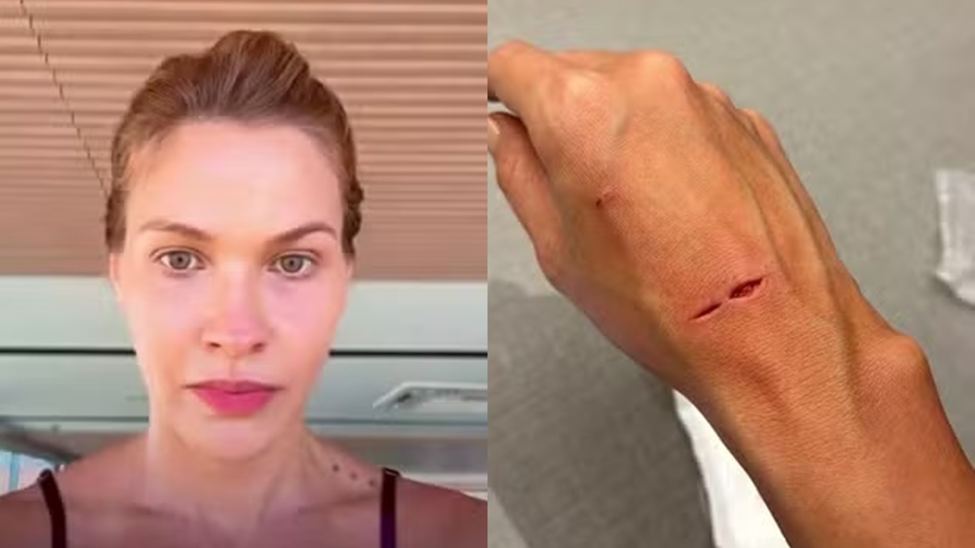 Andressa Suita sofre corte profundo após box do banheiro estourar: “Precisou dar ponto”
