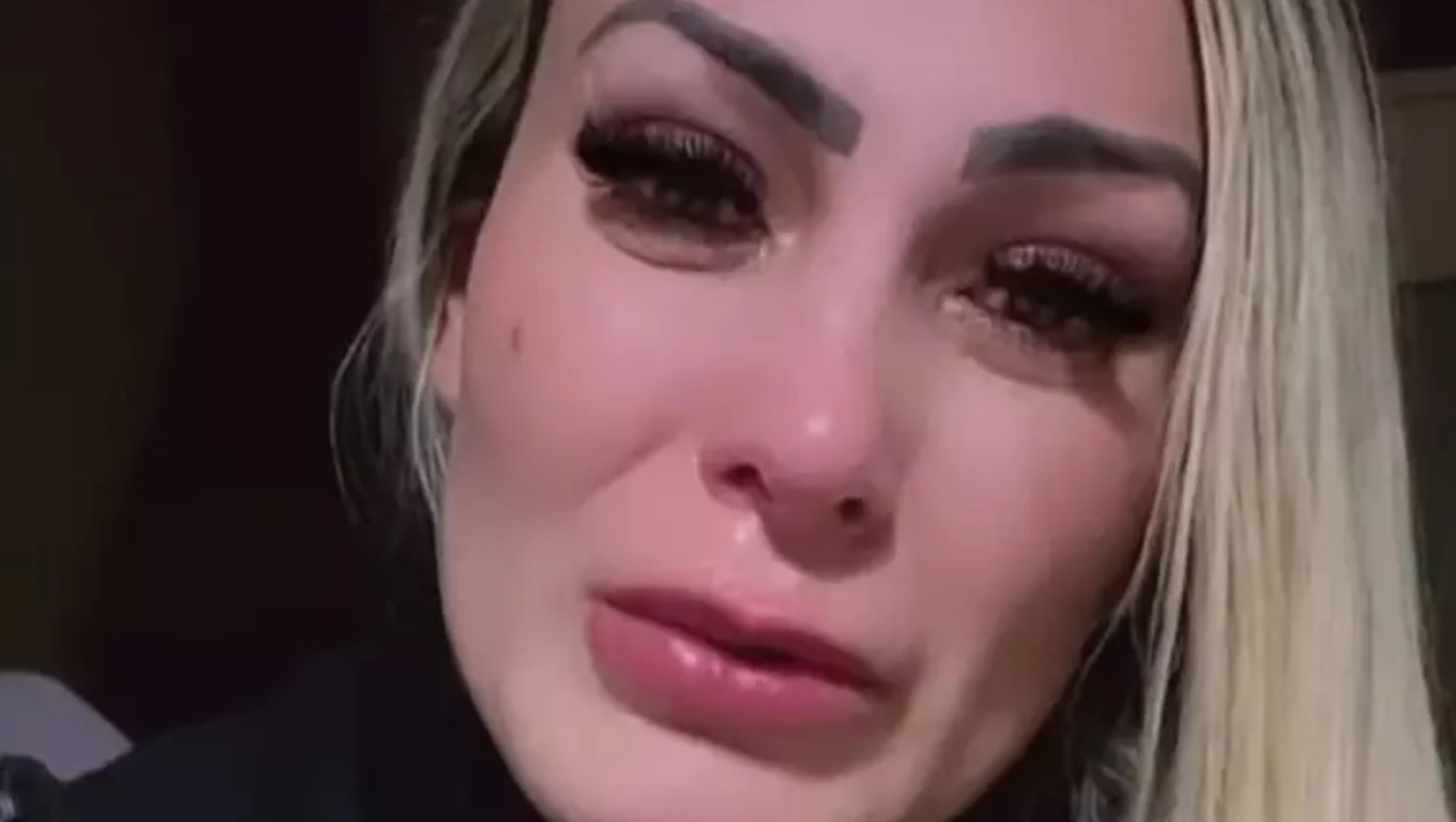 Andressa Urach assusta ao aparecer com o rosto inchado após corte com taça durante briga