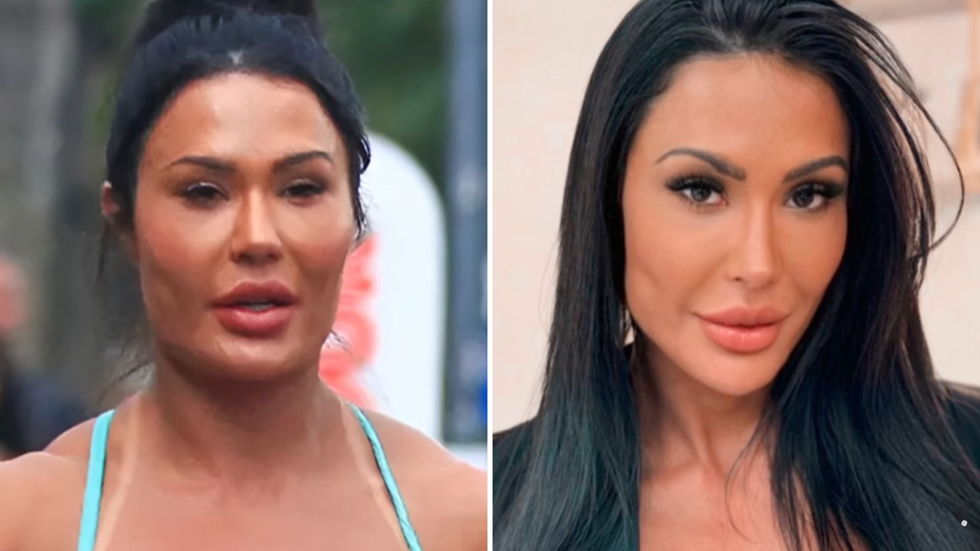 Gracyanne Barbosa remove harmonização e rosto fica irreconhecível: veja antes e depois