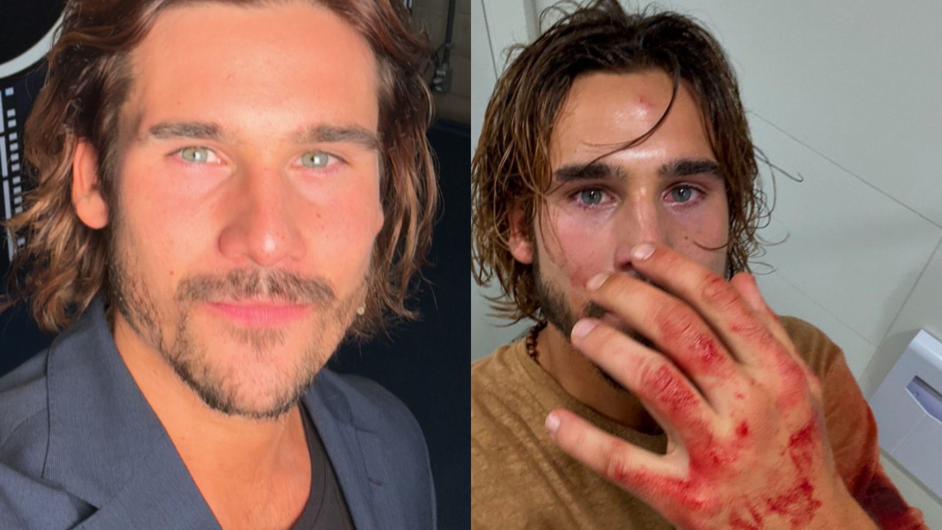 Nicolas Prattes surge com a mão ensanguentada e preocupas fãs: “Foi de verdade”