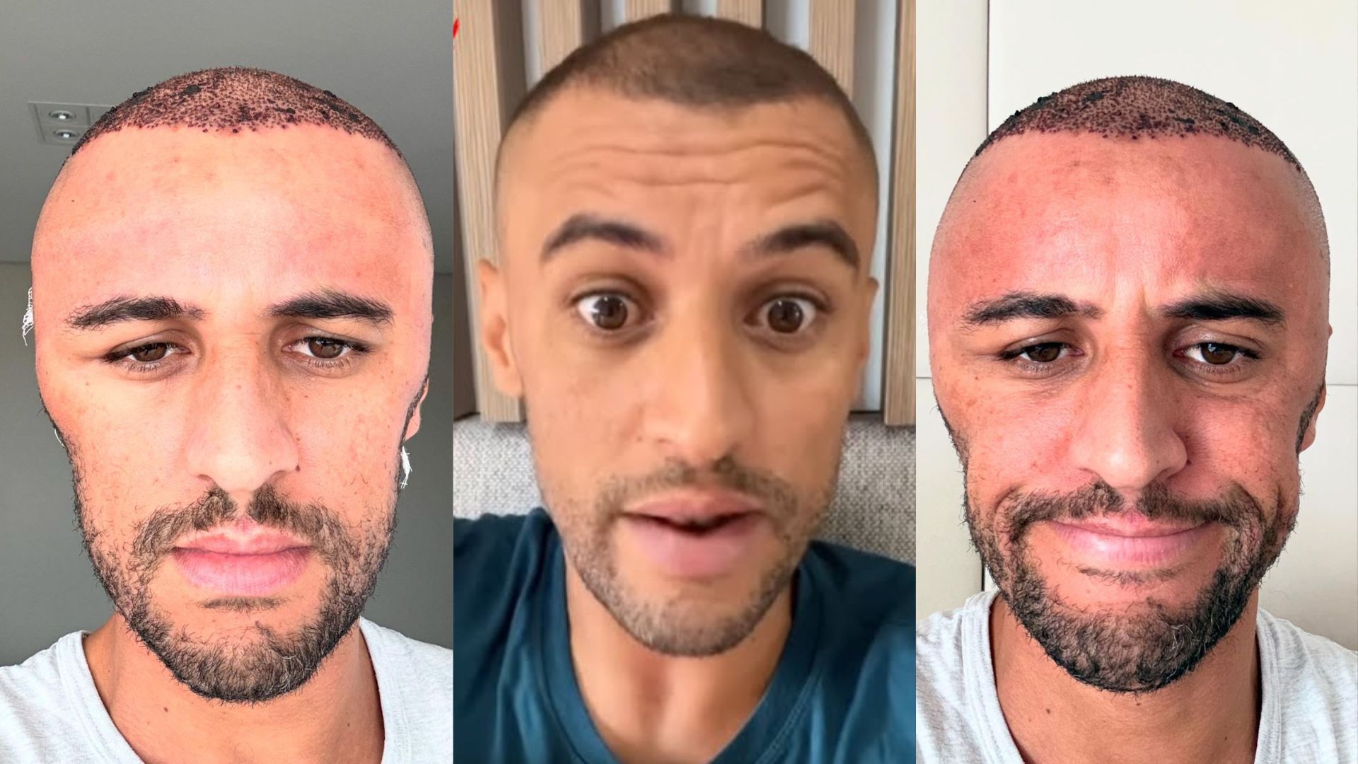 Influenciador apresenta inchaço bizarro e fica cabeçudo após desrespeitar orientações médicas