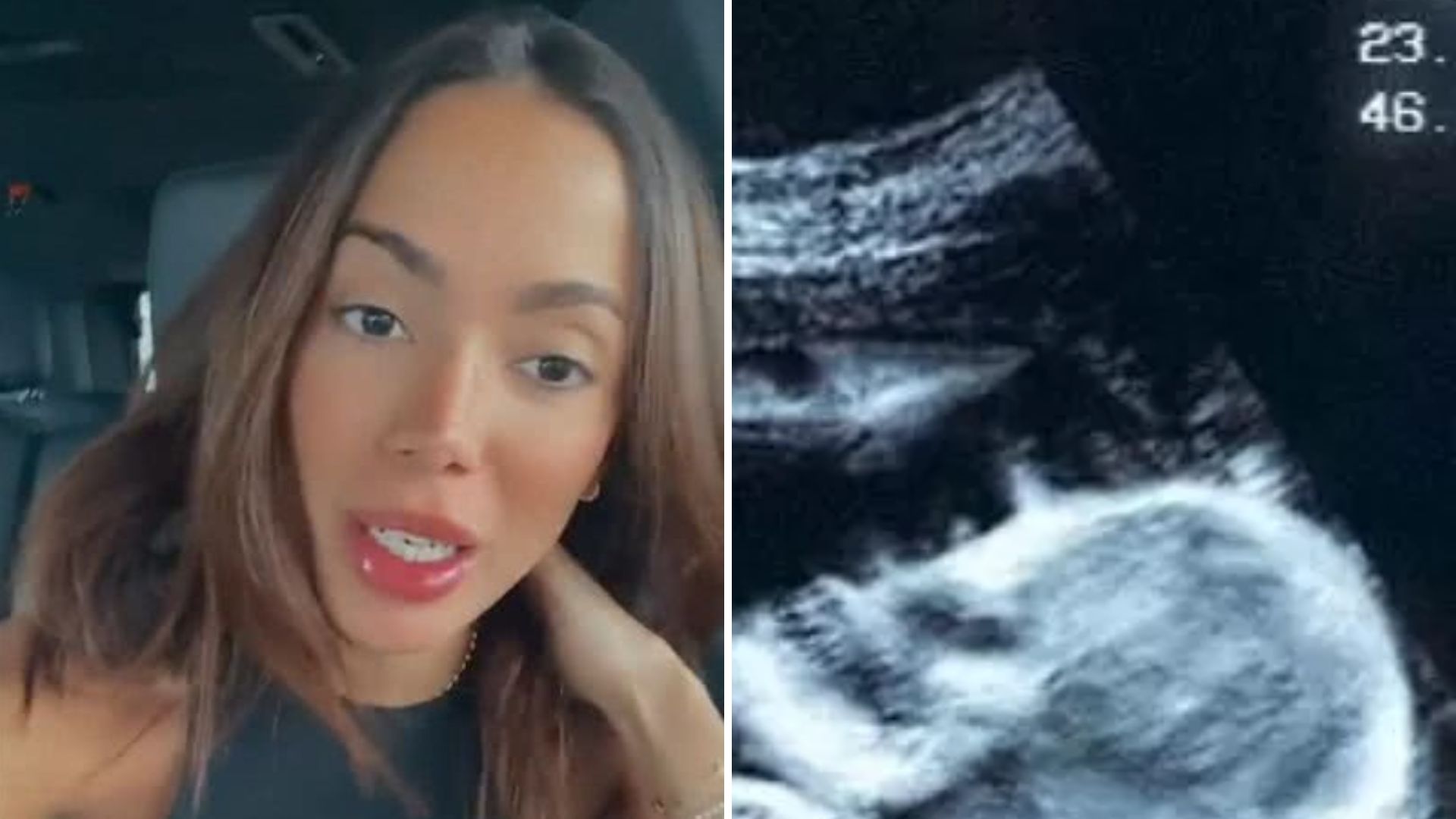 Grávida? Anitta mostra ultrassom inesperado após foto grávida: ‘Ele não é lindo?’