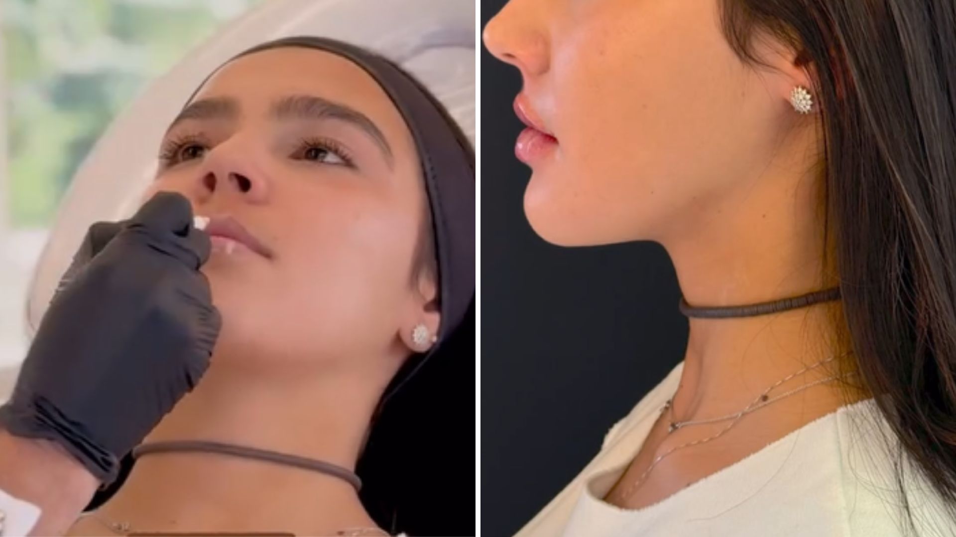 Nora de Angélica e Huck harmoniza o rosto com 16 anos; veja antes e depois