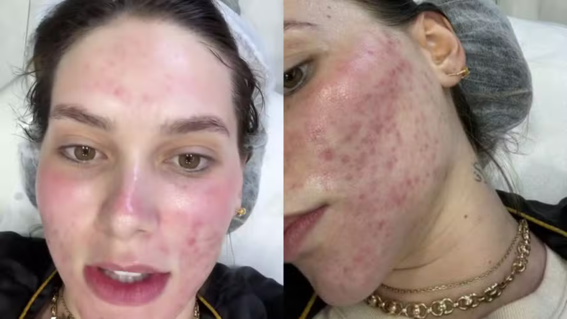 Virginia Fonseca assusta seguidores ao mostrar rosto com marcas
