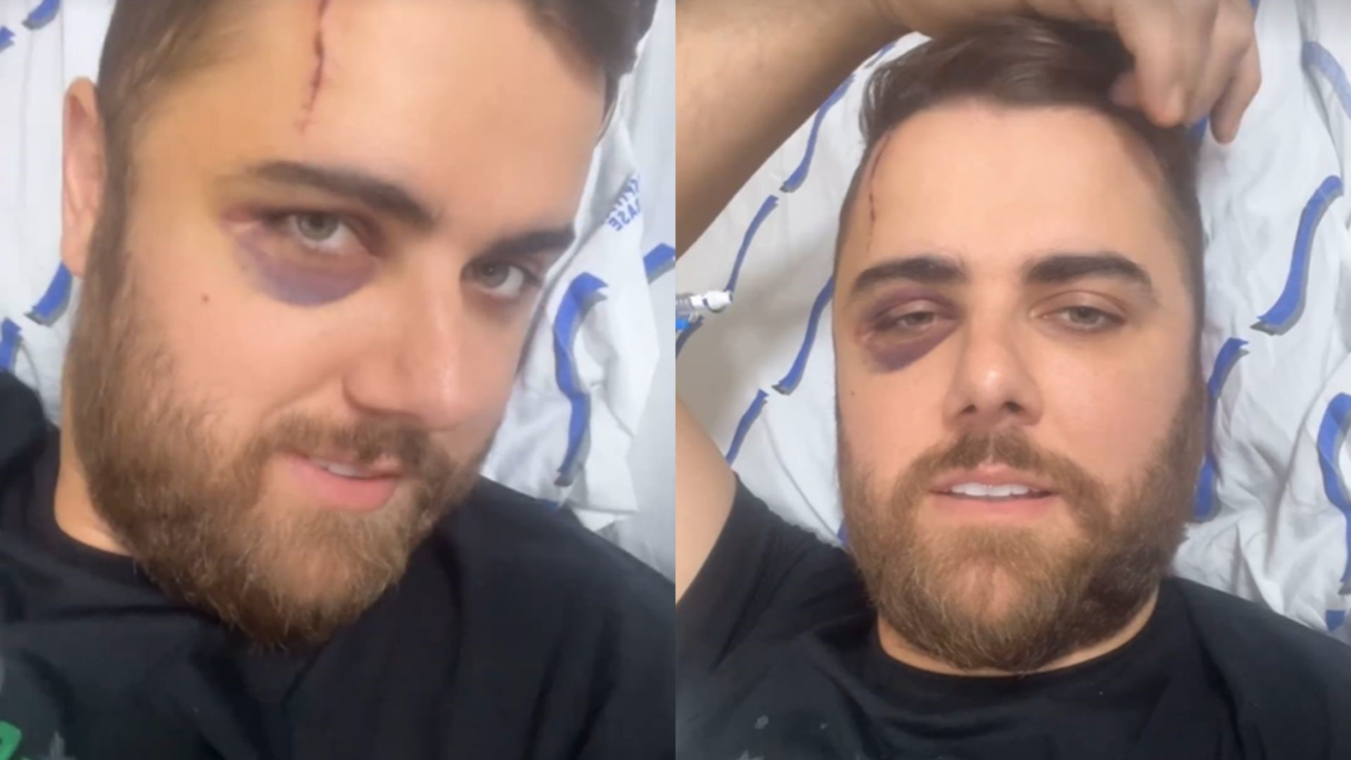 Zé Neto surge com o olho todo roxo e deixa fãs preocupados: “Incidente”