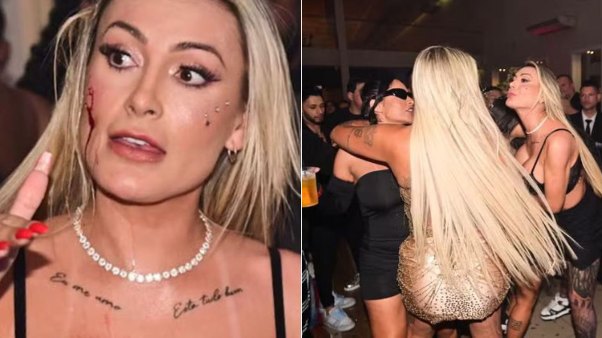 Andressa Urach está emocionalmente abalada após ter rosto rasgado em briga, diz empresário