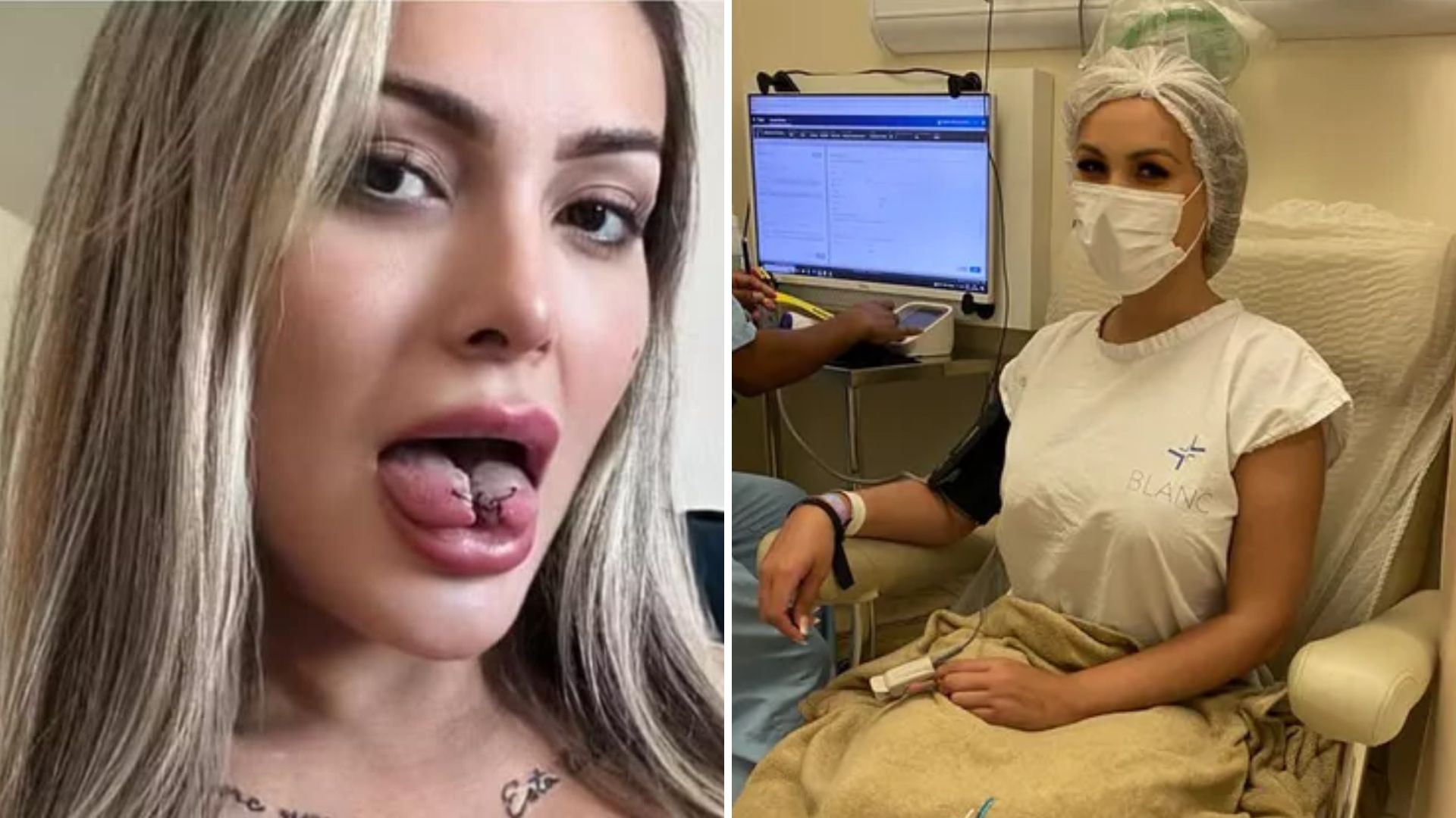 Andressa Urach fez quantas cirurgias plásticas? Número colossal vem à tona