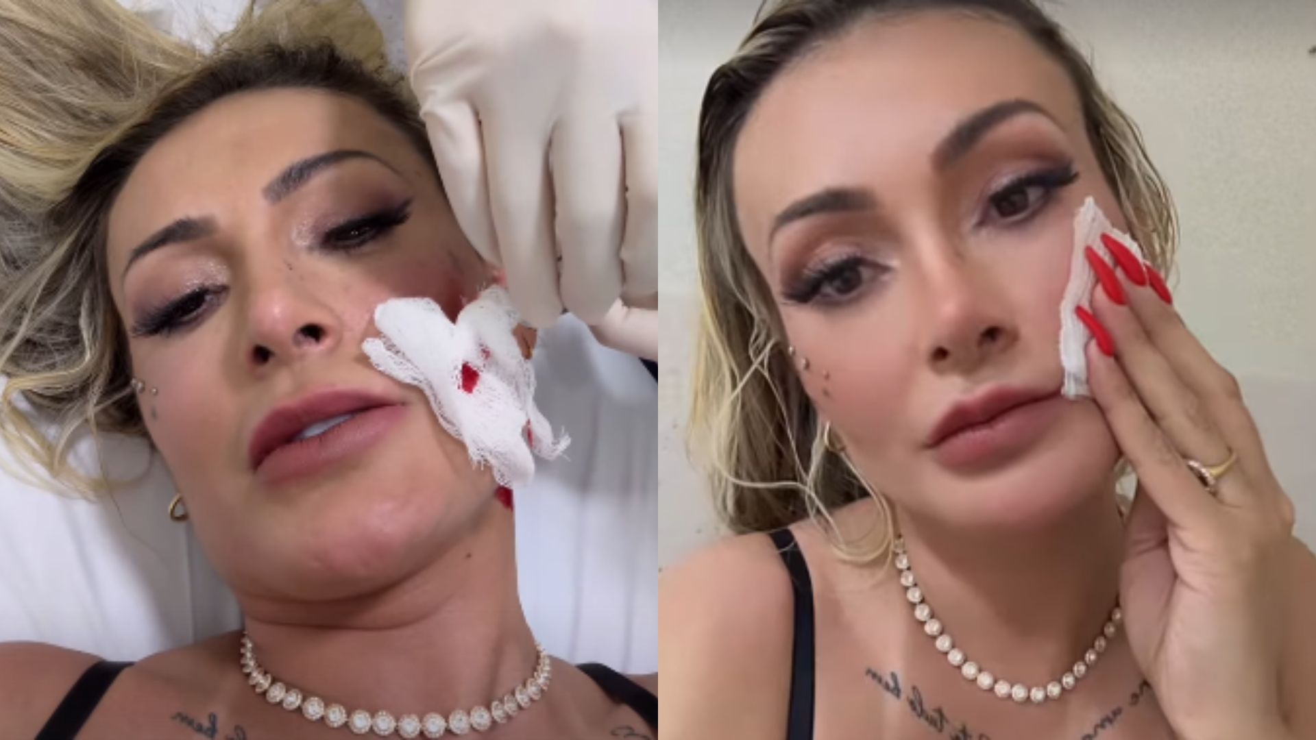 Andressa Urach apanha de Juju Ferrari e é hospitalizada ensanguentada: ‘Vai ter volta’