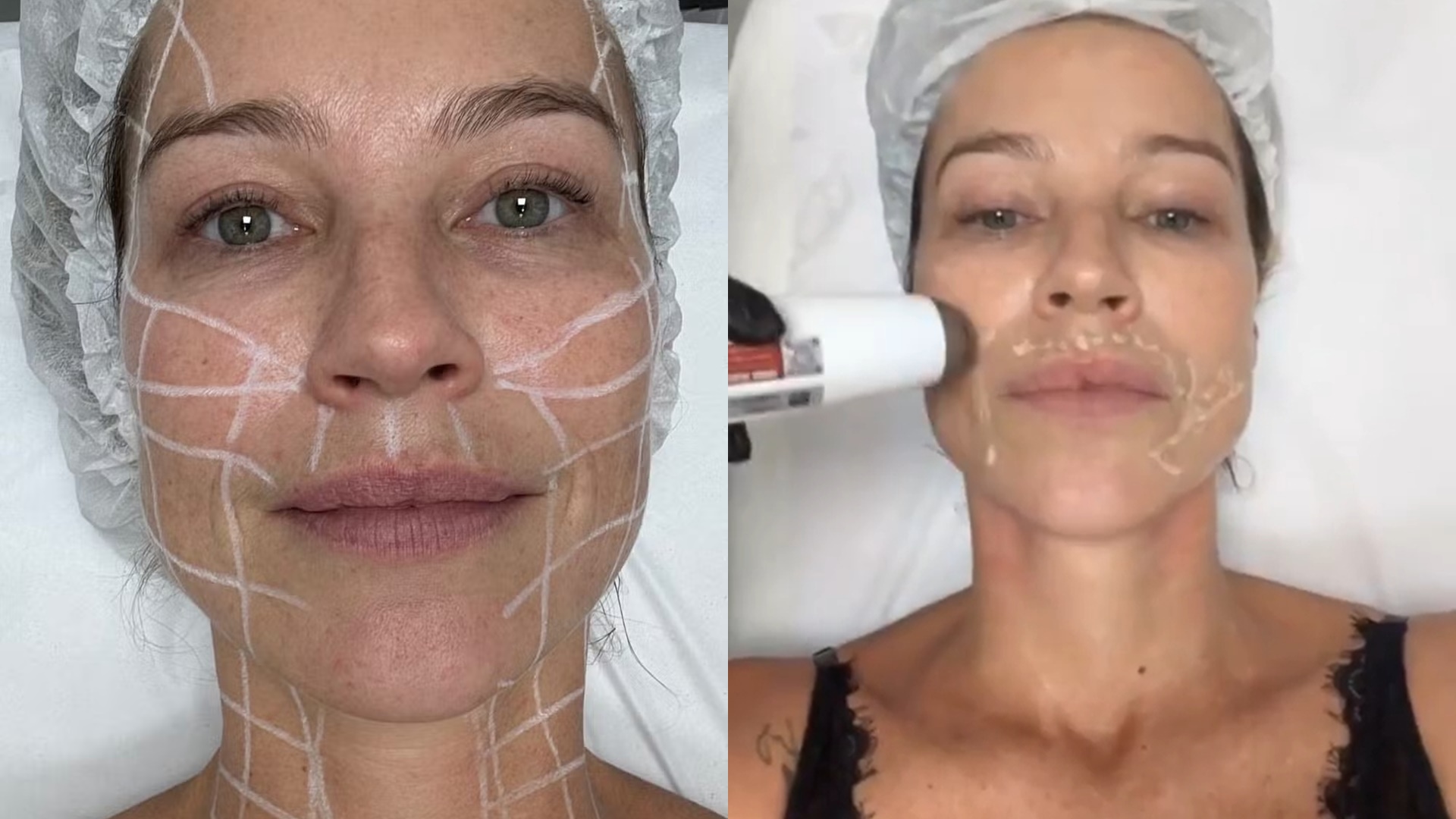 Luana Piovani detalha novos procedimentos no rosto e pescoço: ‘Mais bonita ainda’