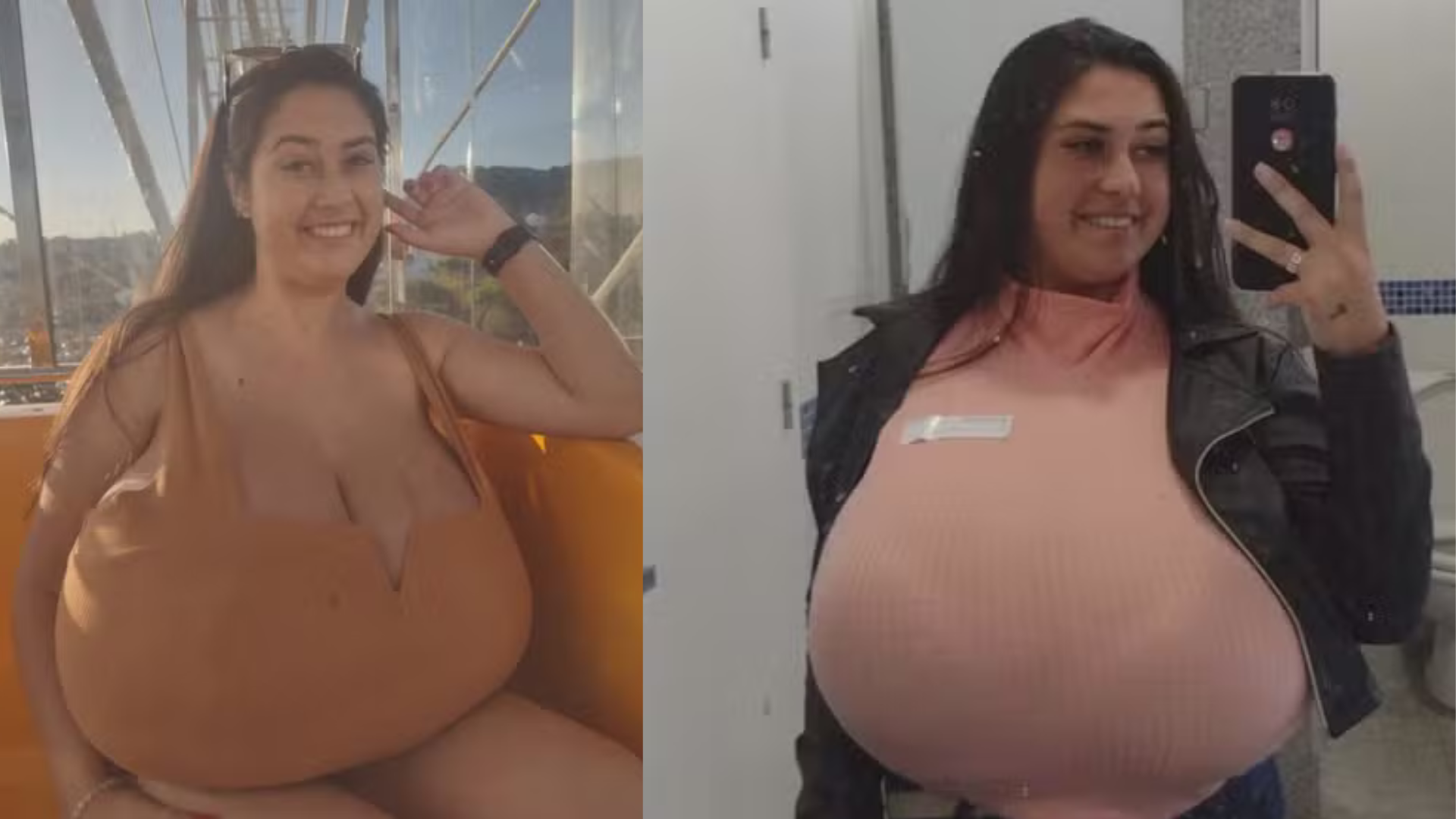 Estudante de 21 anos faz cirurgia para retirada de mama de 10kg