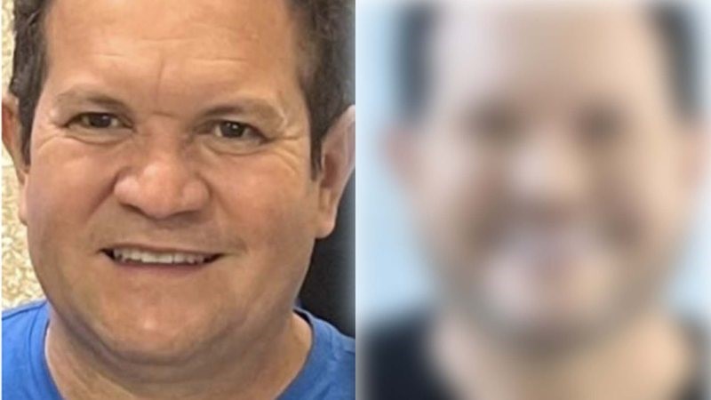 Ximbinha passa por mais um processo de harmonização e exibe resultado: ‘Mais mudanças’