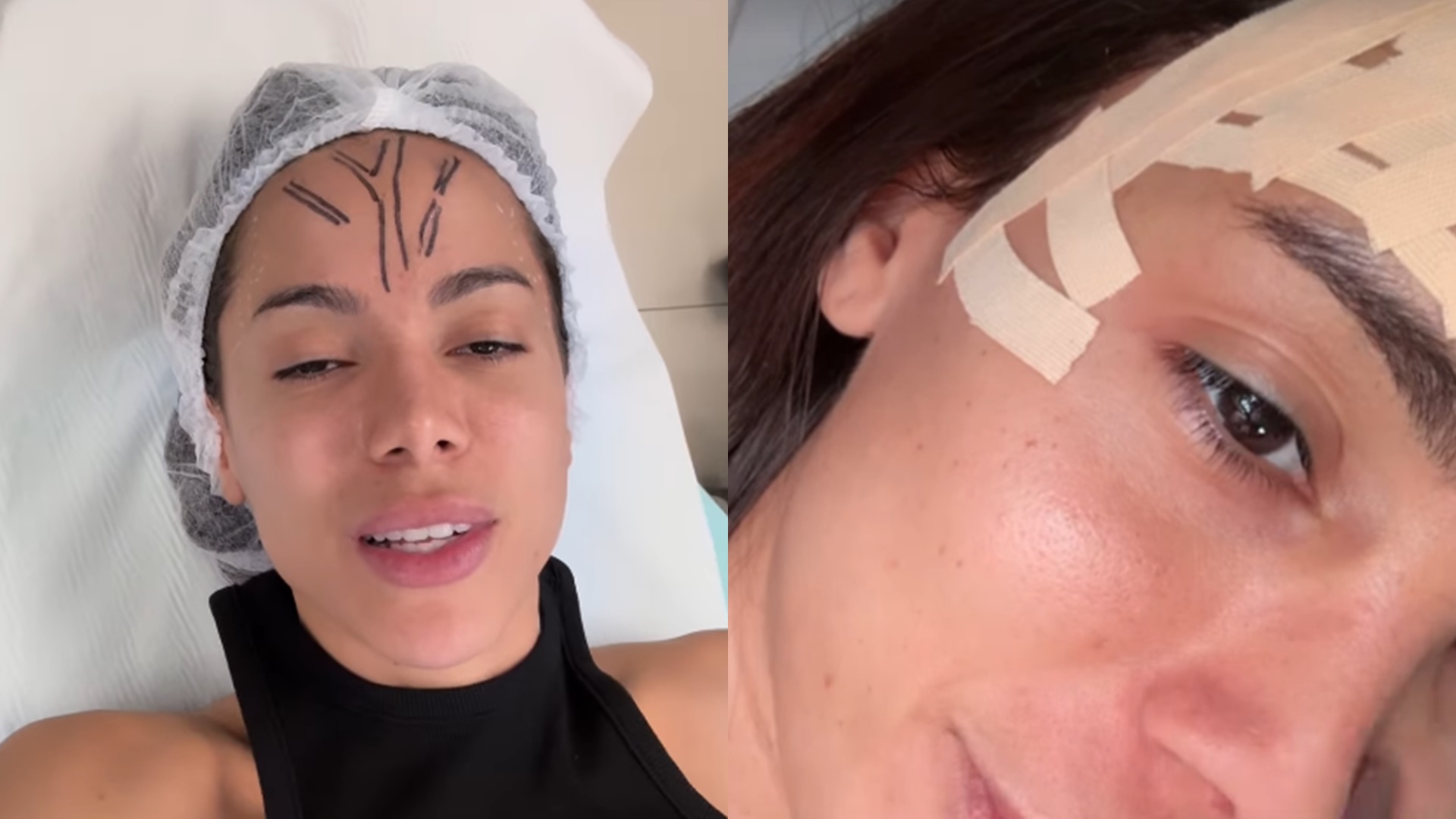 Anitta se pronuncia após procedimento para retirar veias do rosto: ‘O quanto é ruim’